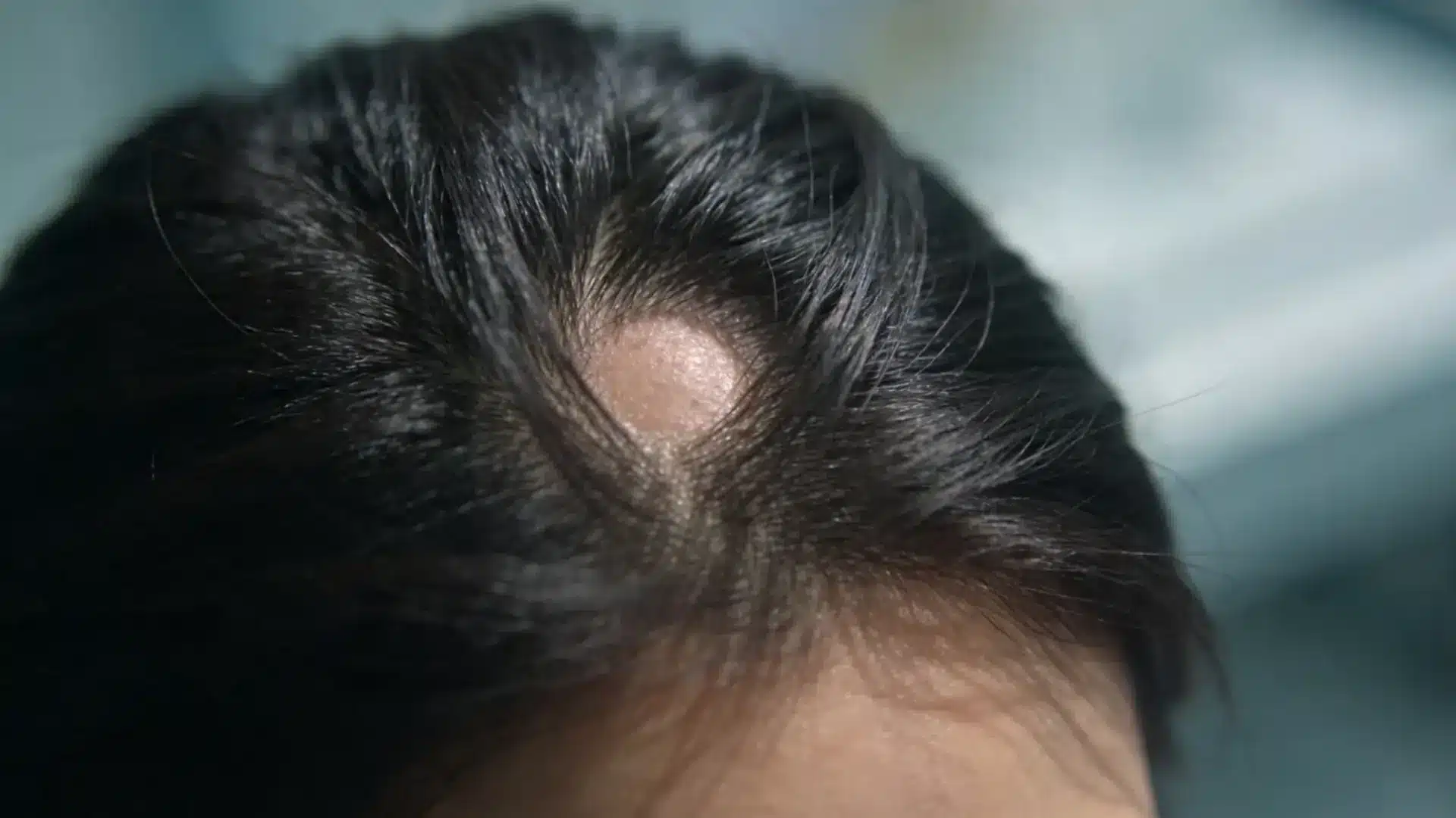 Close-up of scalp with a round bald patch, showing localized hair loss condition