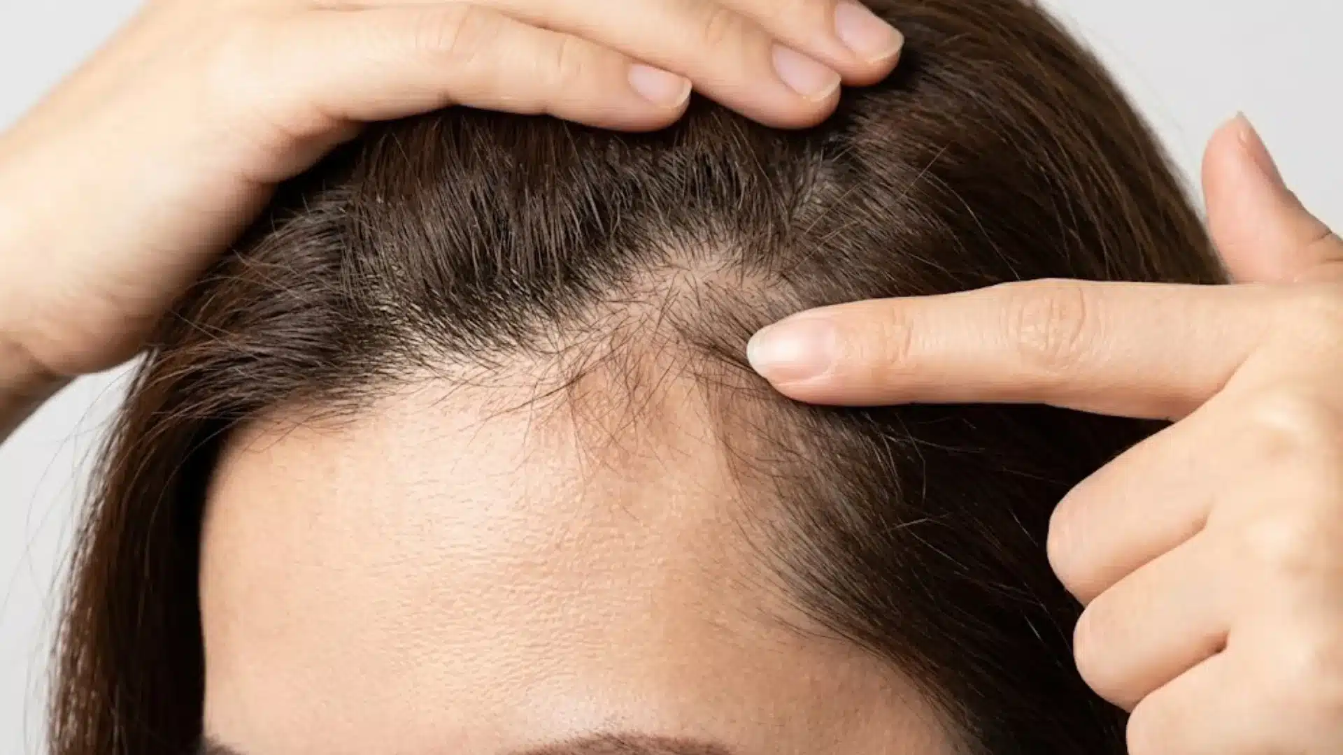 Close view of woman showing hair thinning and visible scalp near front hairline area
