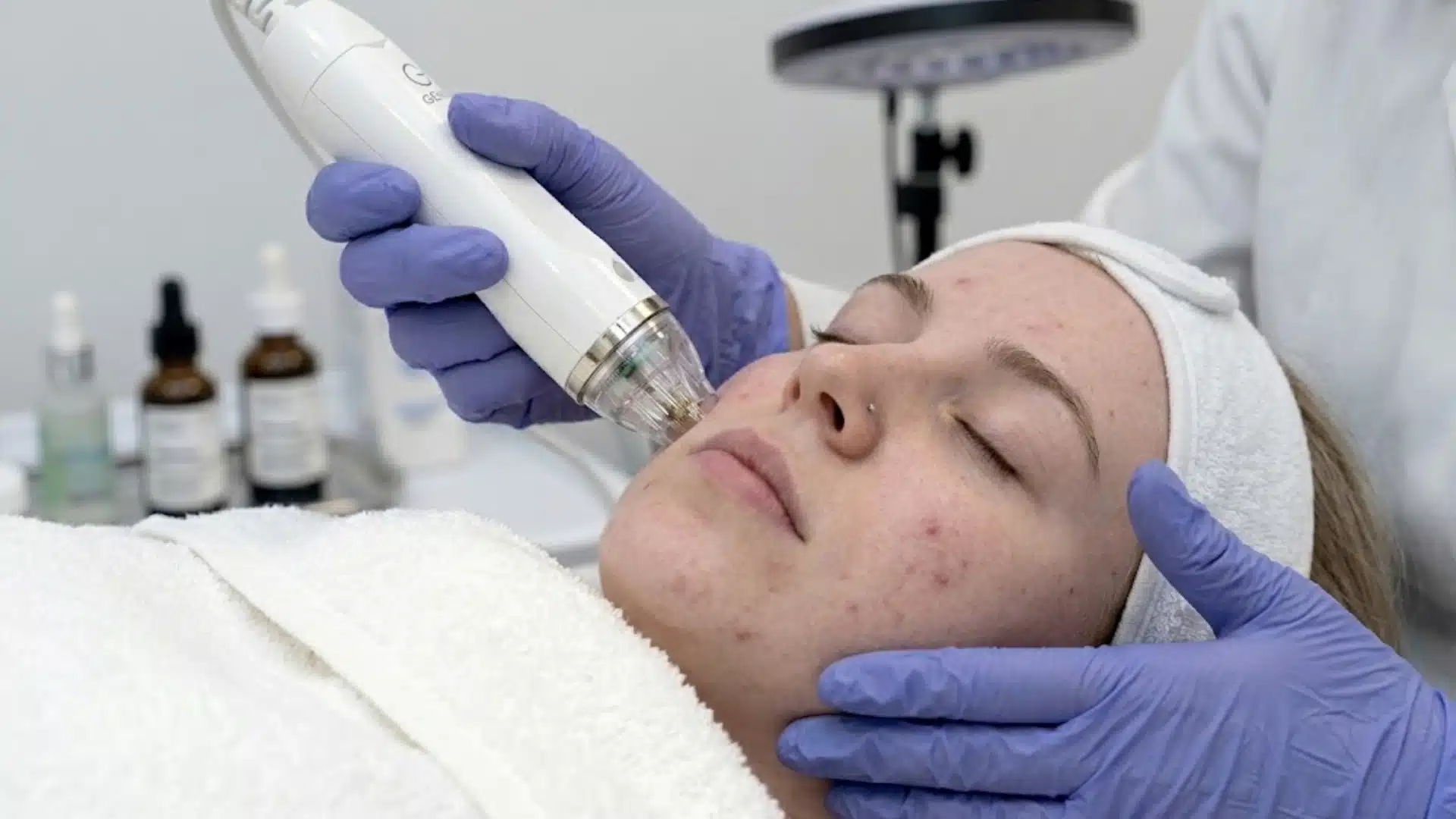 Dermatologist performing microneedling treatment for acne scars and uneven facial skin texture on cheeks