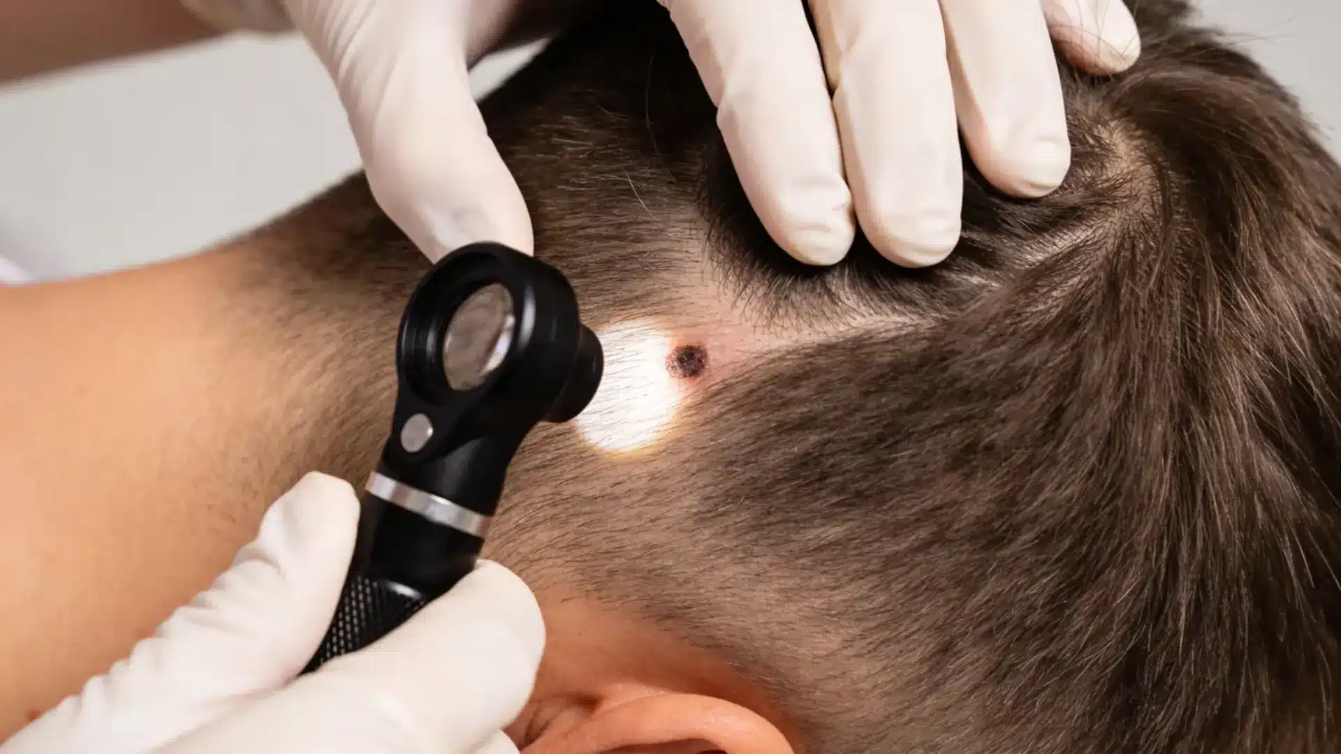 Should You Worry About a Mole on Your Scalp?