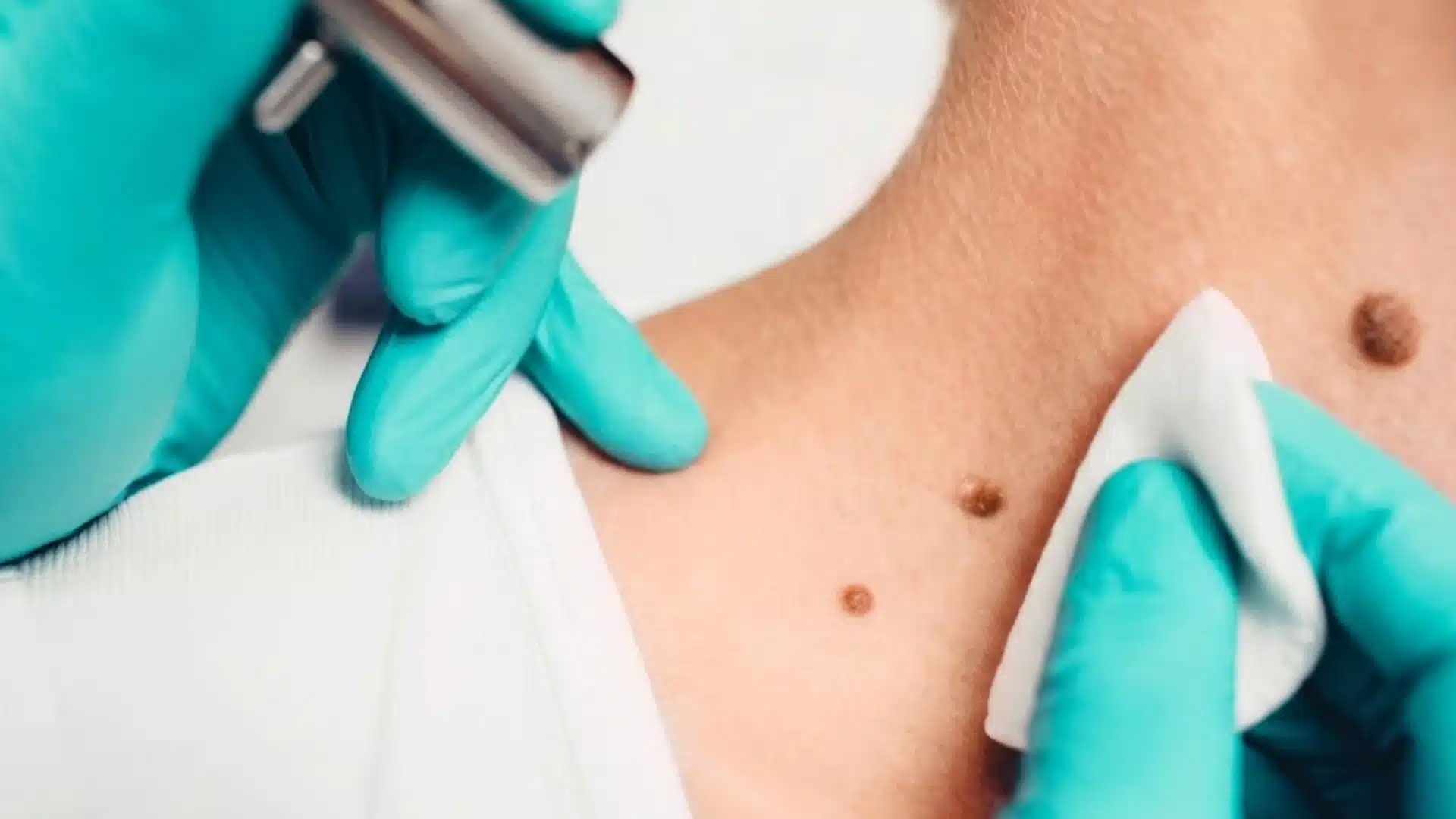 Doctor performing mole removal on neck using medical tool while cleaning skin area during procedure