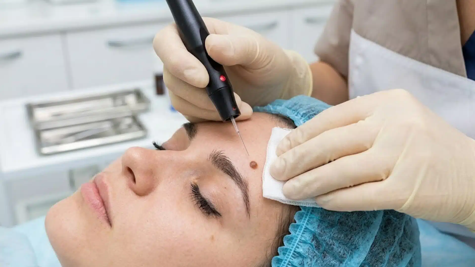 Doctor using laser device to remove mole from woman's forehead during clinical skin treatment