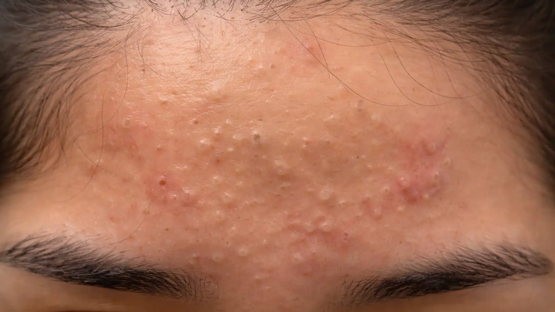 Forehead with clusters of small whiteheads and bumps near the hairline, showing mild redness and uneven skin texture in natural lighting