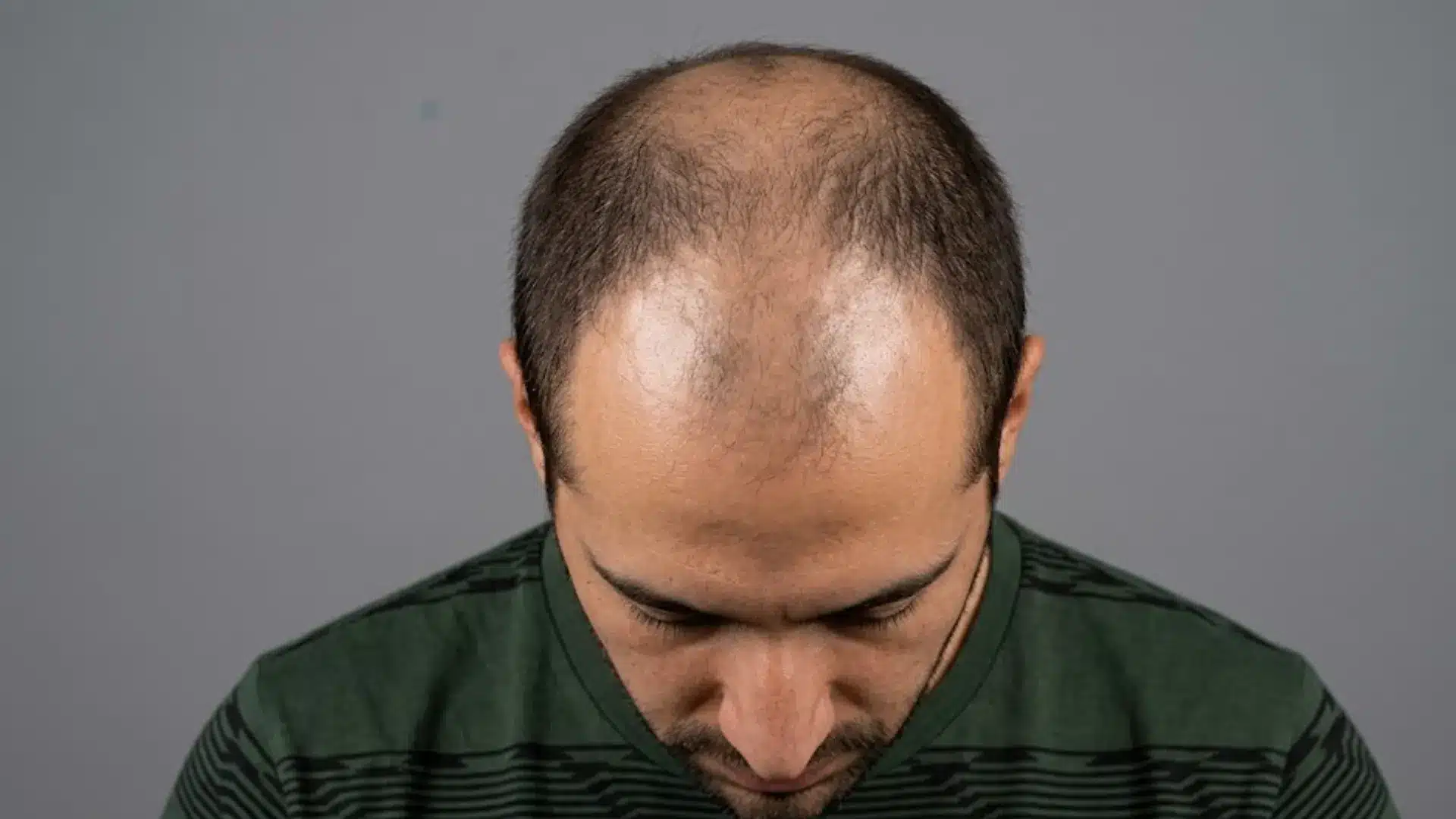 Man with thinning hair and visible scalp showing possible dormant or dead hair follicles on crown area