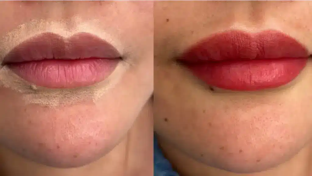 Side by side close up of lips before treatment with uneven tone and after with brighter fuller defined color