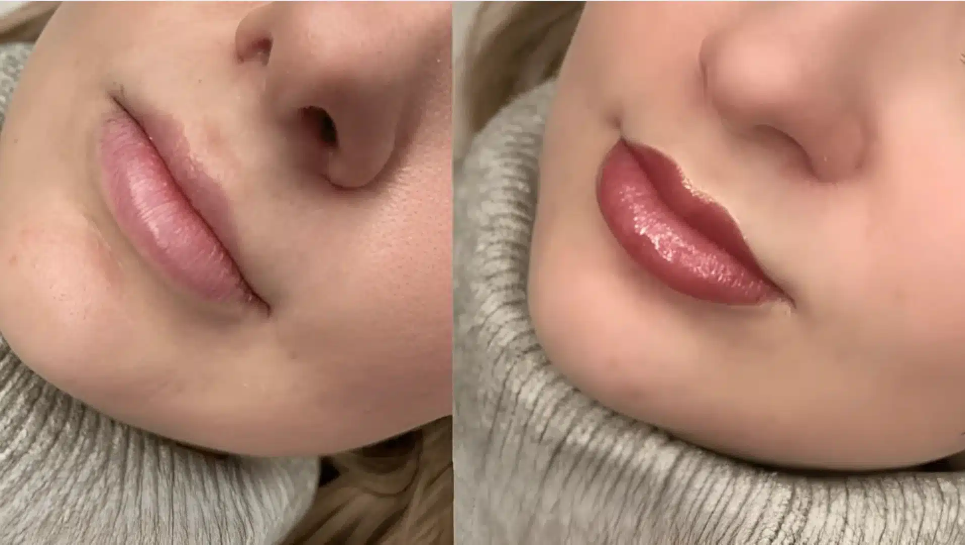 Side by side close up of lips before treatment with dryness and after with fuller smoother glossy appearance