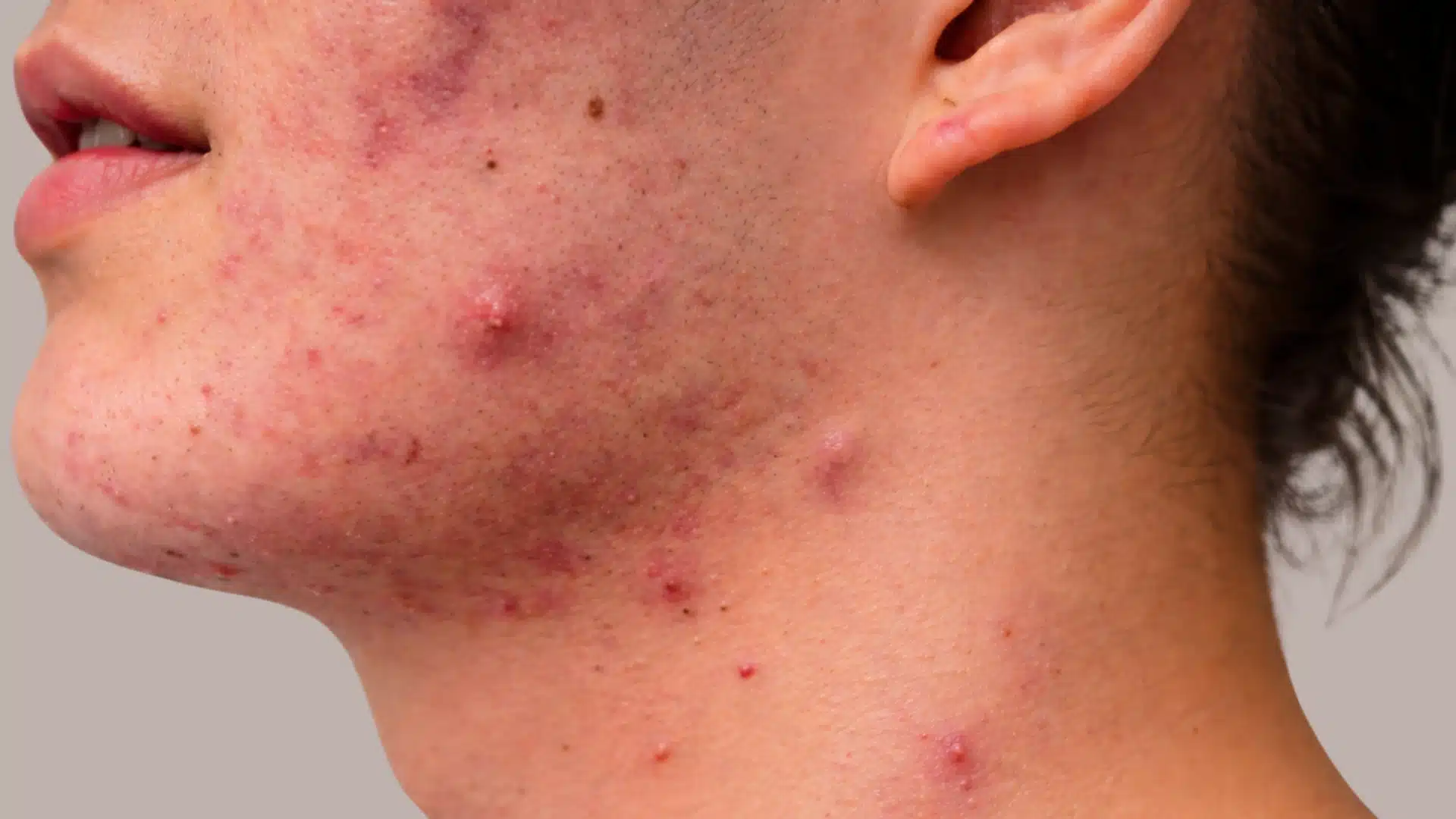 Side profile of a person with inflamed acne across the jawline, cheek, and neck, showing red bumps, cystic spots, and uneven skin texture in soft natural lighting
