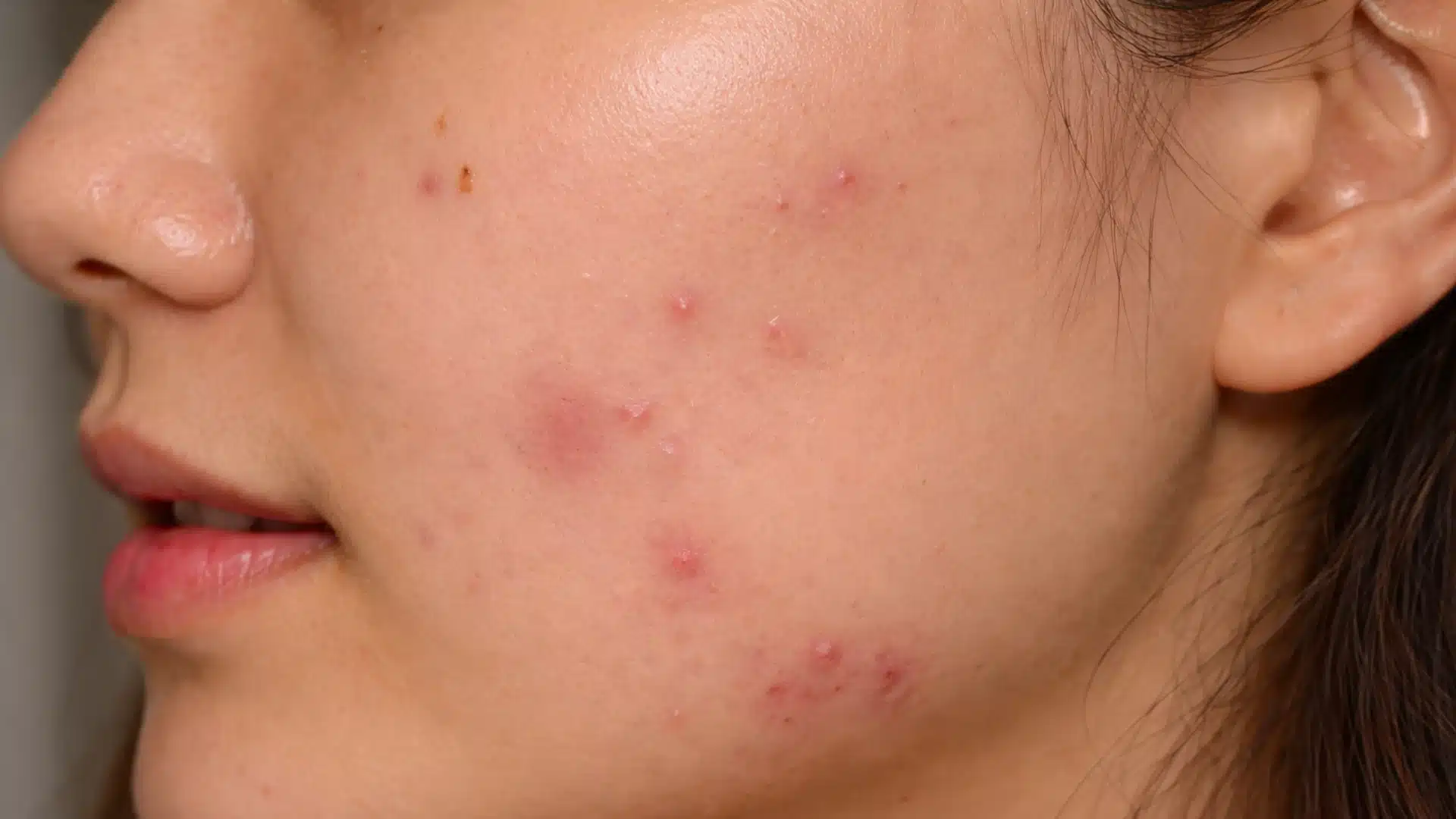Side profile of a person with visible acne on cheek and jawline, showing inflamed pimples and uneven skin texture under natural lighting