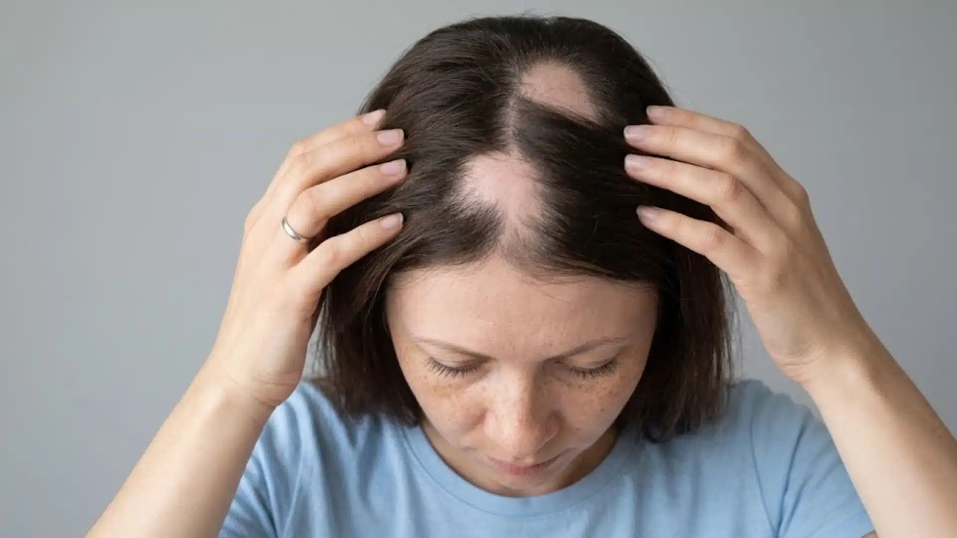 Woman examining scalp with visible patchy hair loss and thinning areas on the top of the head
