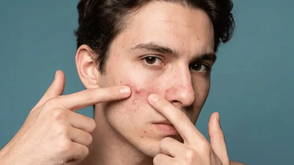 Young man squeezing a red popped pimple on his cheek with visible acne and irritated skin on his face