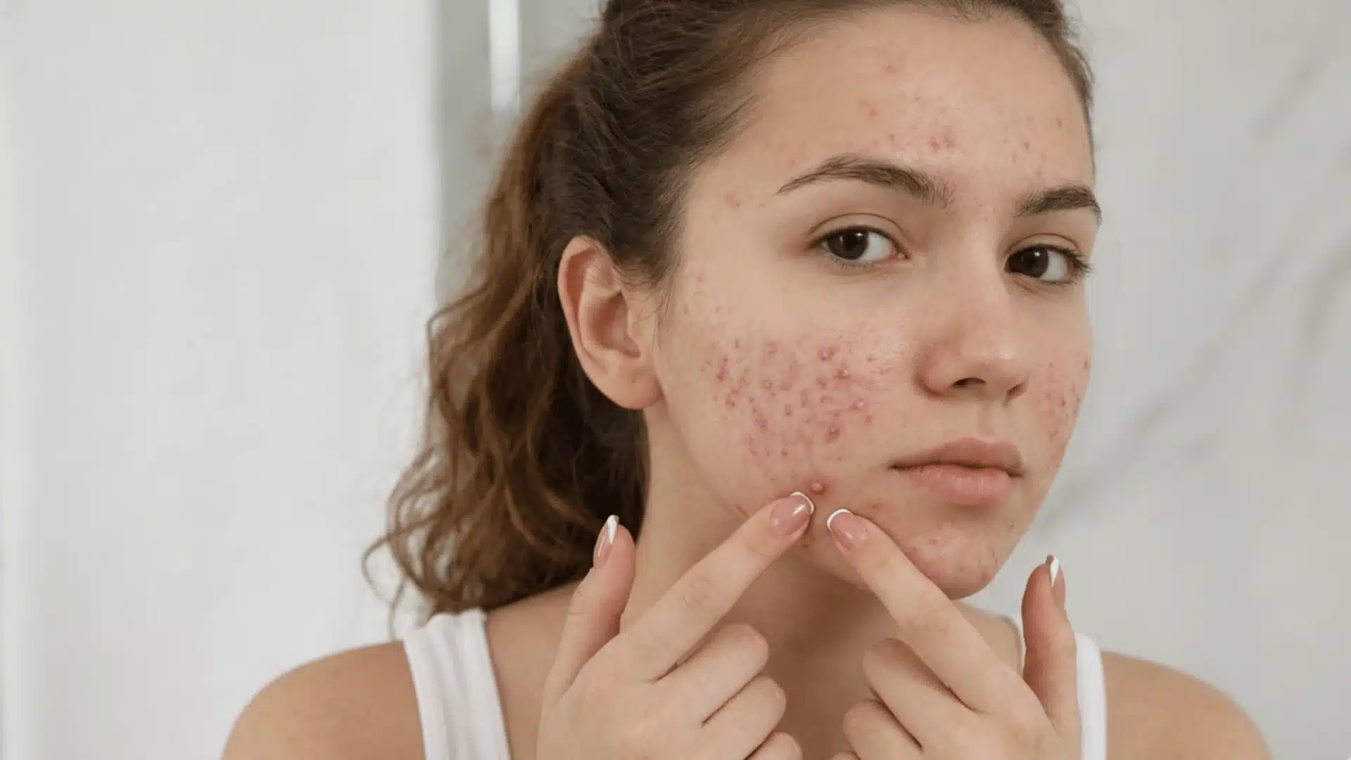 Young woman touching facial acne and pimples on her cheeks while looking at the camera in a bright indoor setting