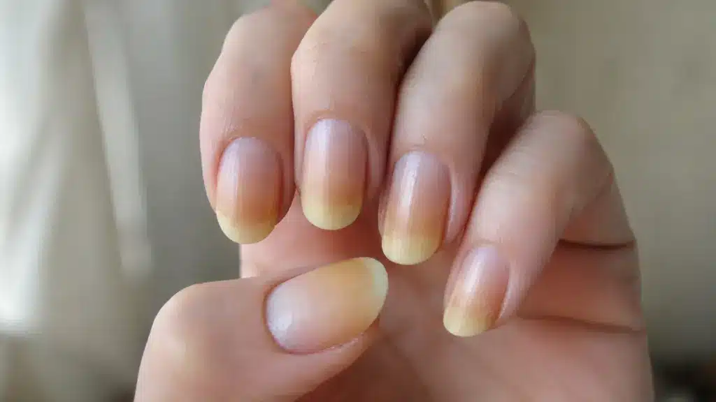 A close-up of a person's hand showing fingernails with noticeable yellow discoloration on the tips