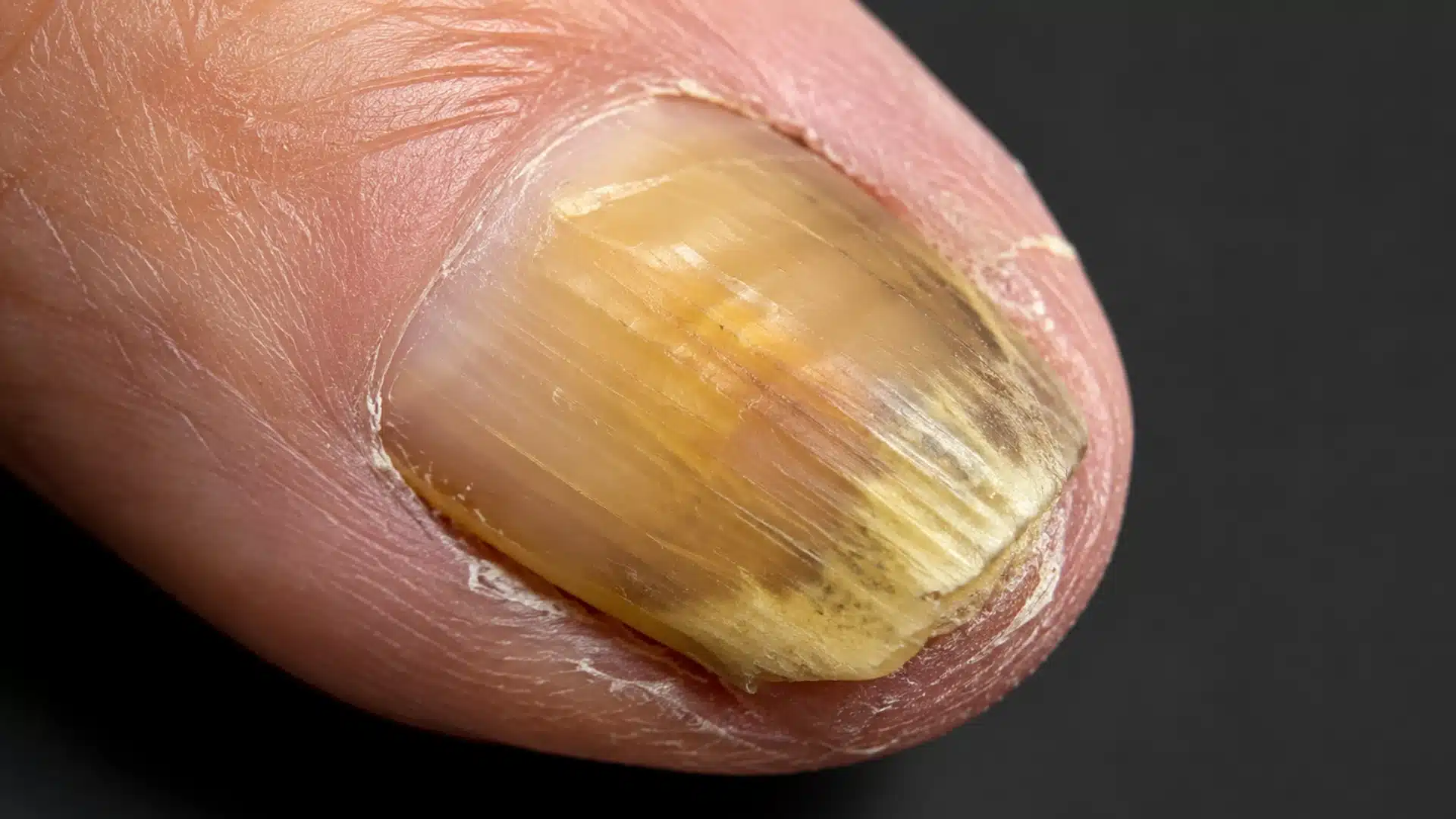 A close-up of a person's fingernail showing severe yellow and brown discoloration, ridges, and thickening