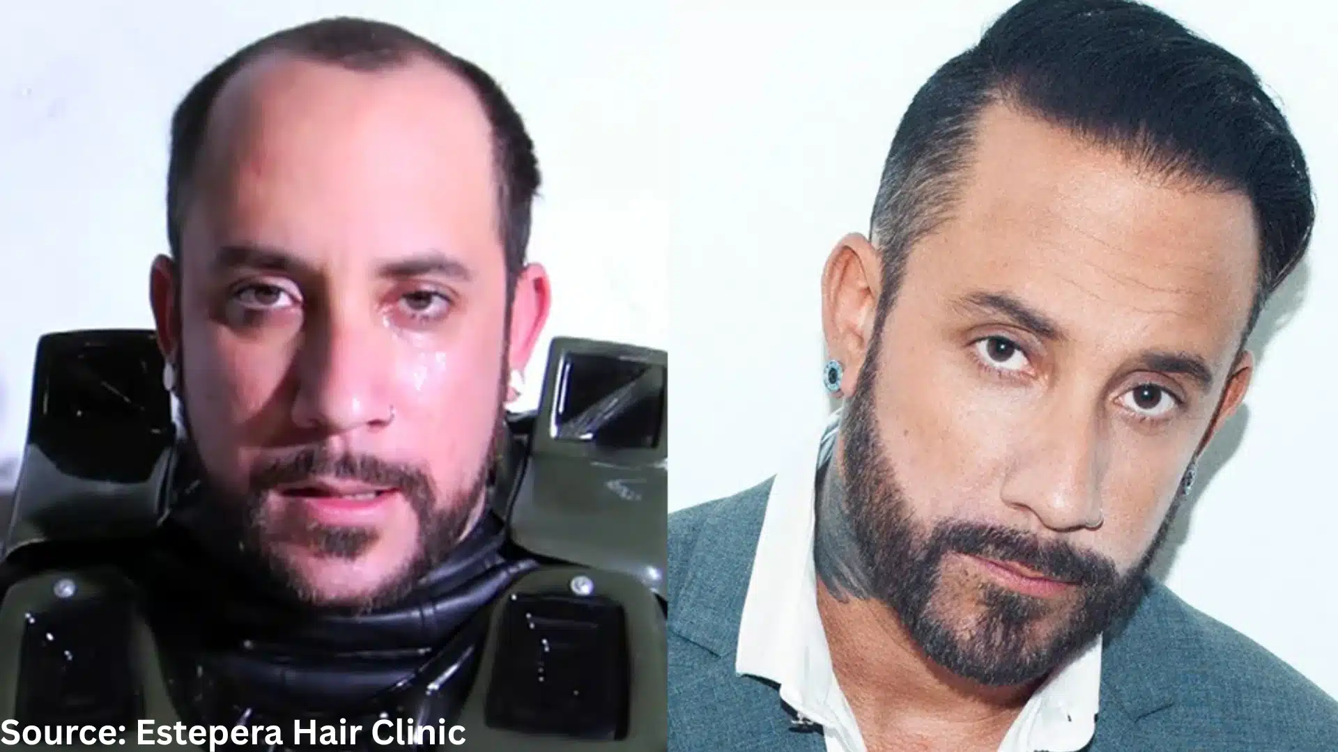 AJ McLean hair transplant before and after