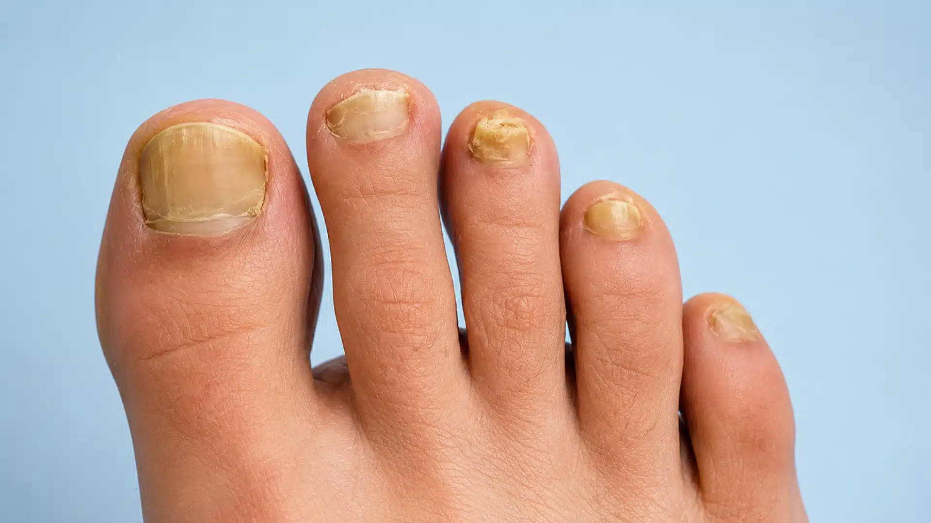 A top-down view of five human toes showing yellowed, thickened, and brittle toenails against a blue background