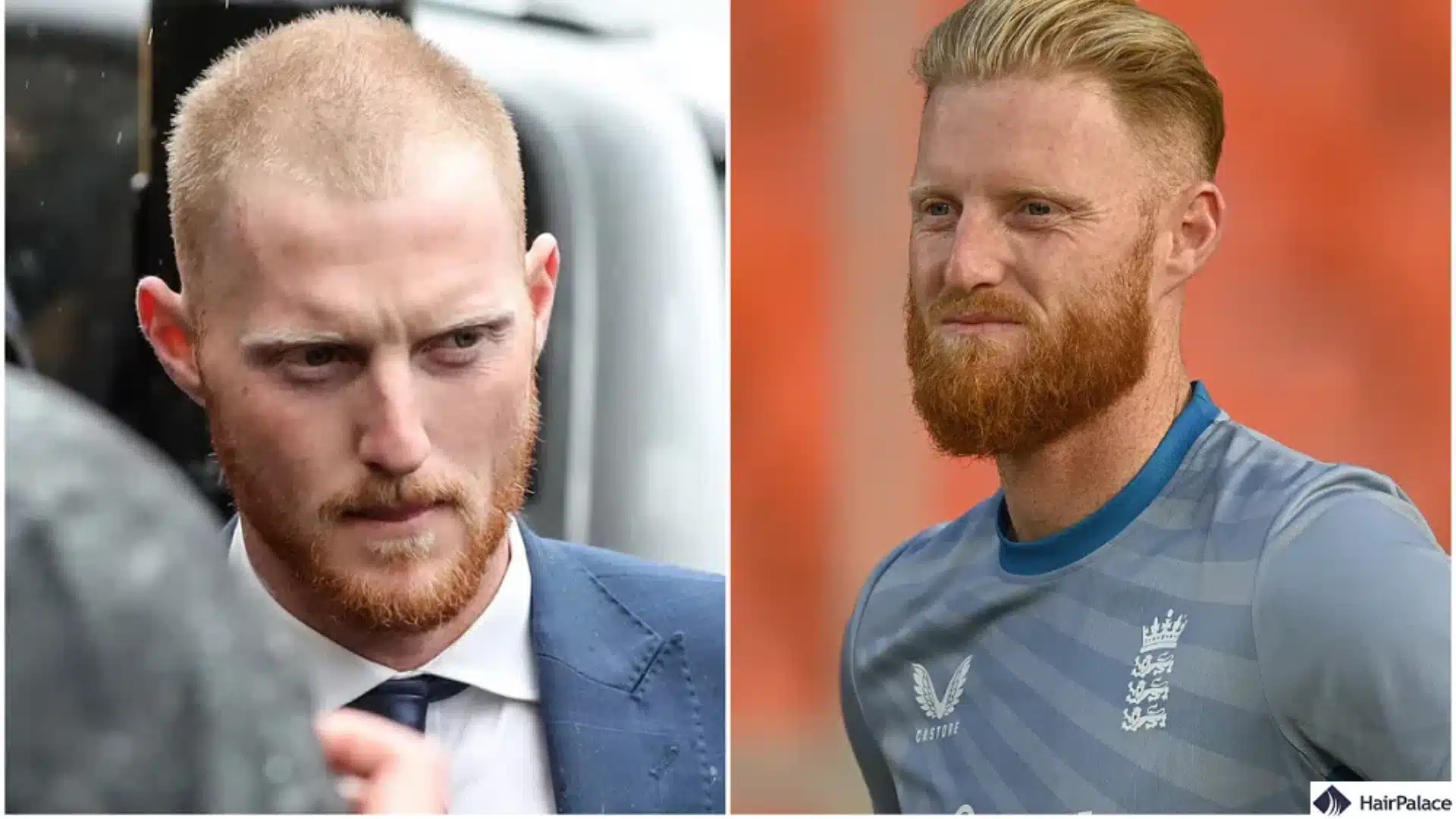 Ben Stokes hair transplant before and after