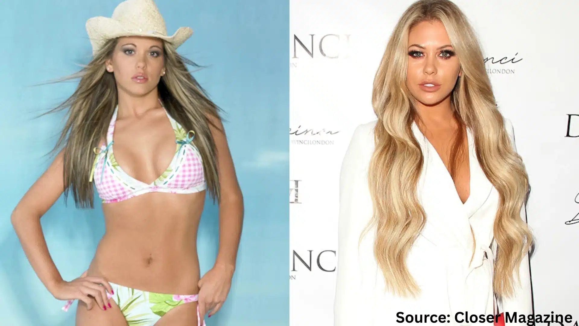 Bianca Gascoigne hair transplant before and after