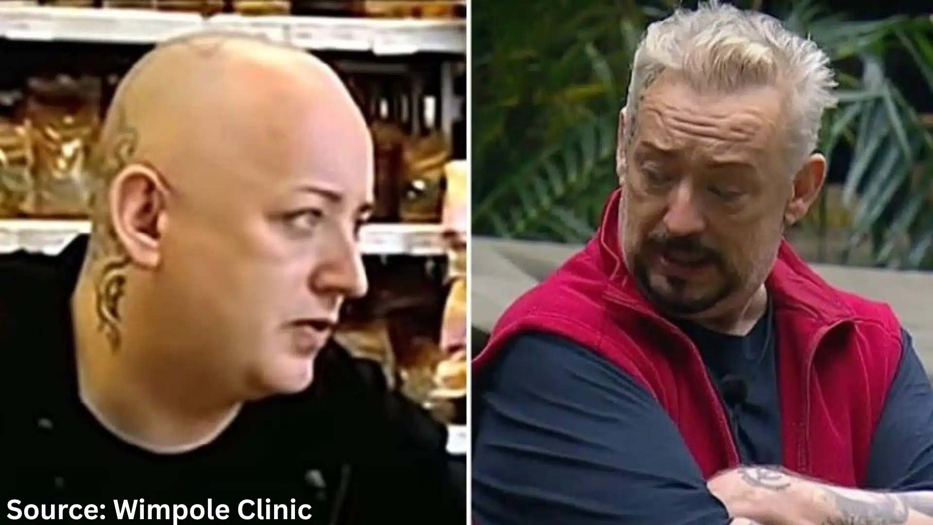 Boy George hair transplant before and after