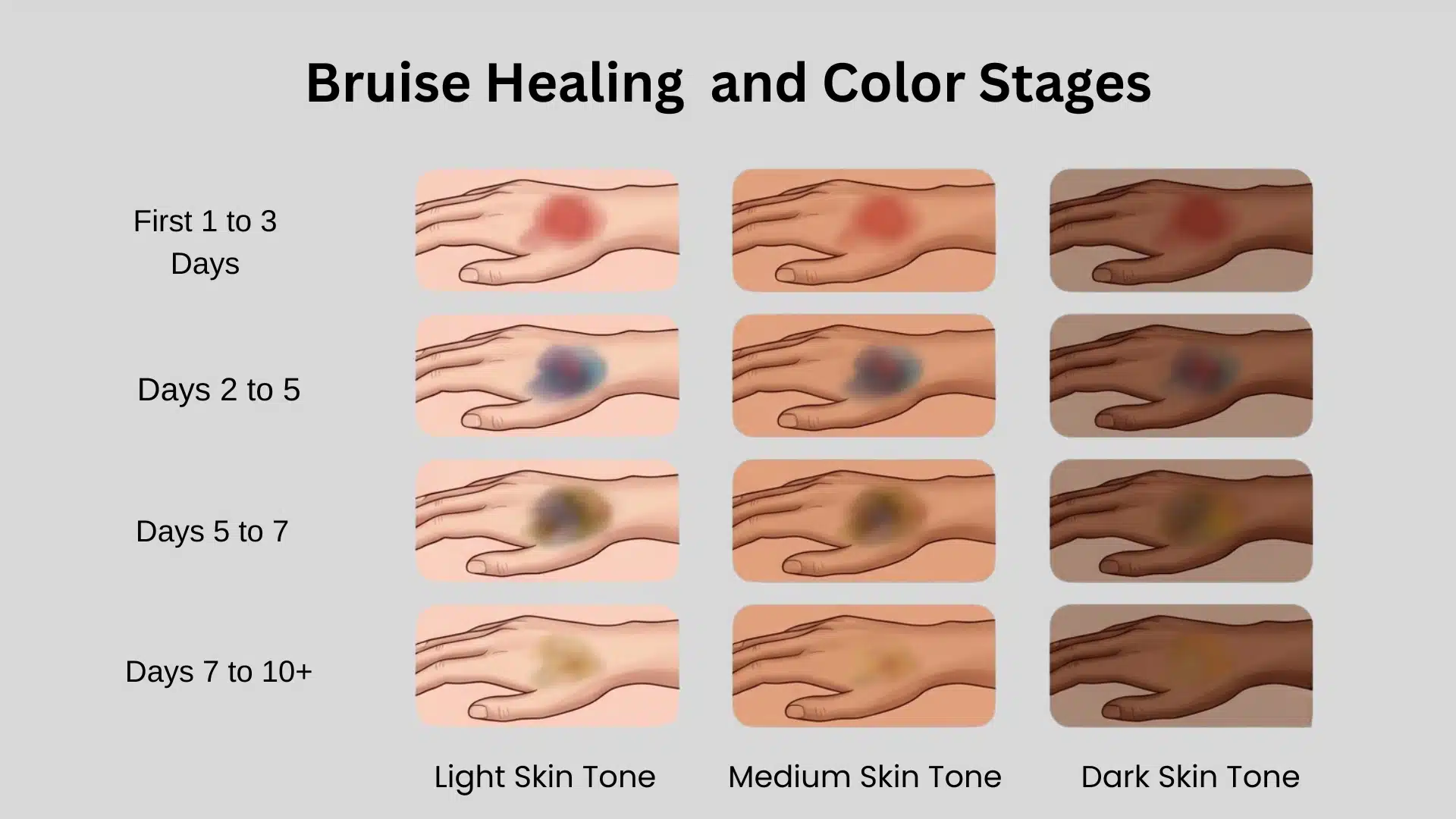 Bruise healing chart showing hand bruise color stages across light, medium, and dark skin tones