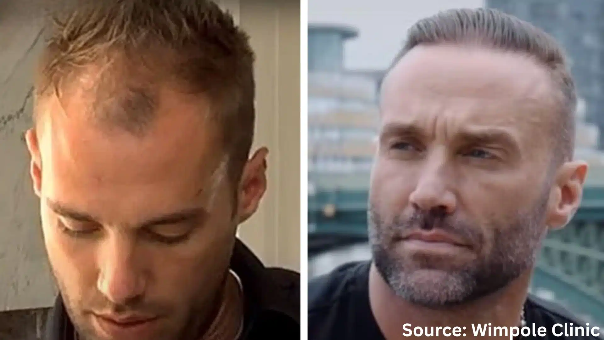 Calum Best hair transplant before and after