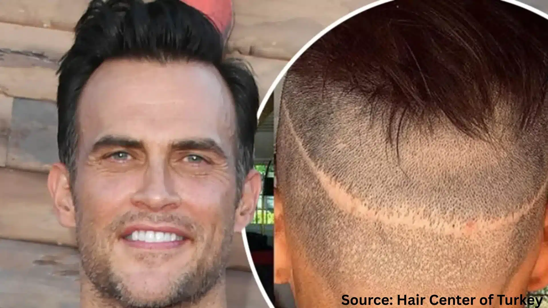 Cheyenne Jackson hair transplant before and after