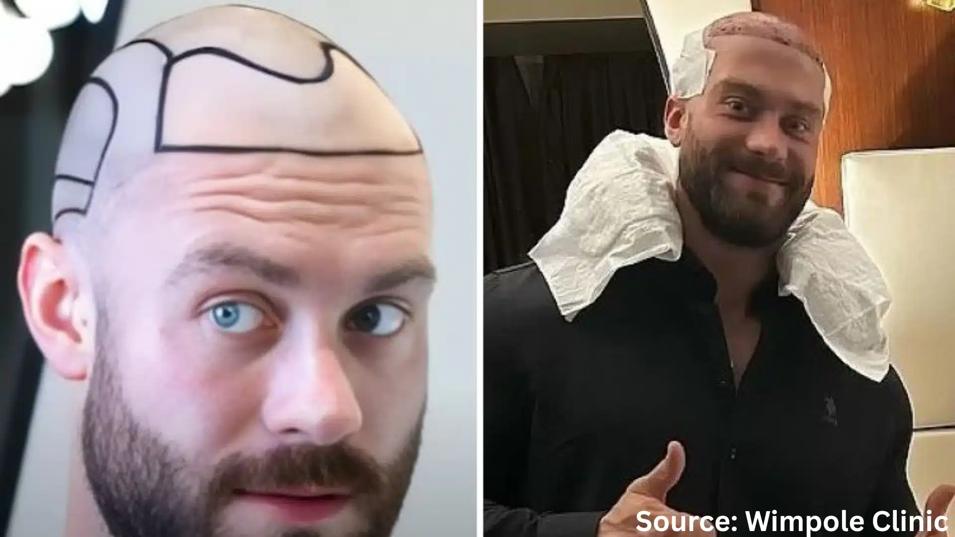 Chris Bumstead hair transplant before and after