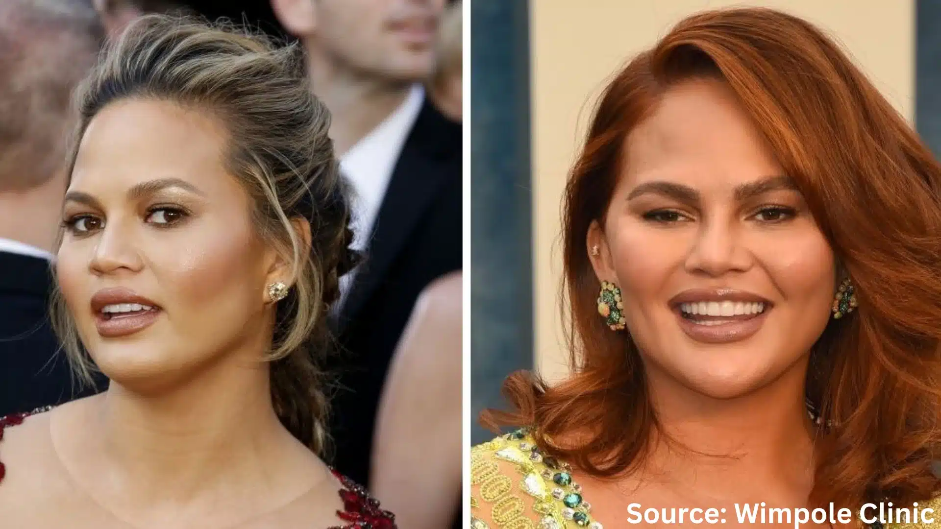 Chrissy Teigen hair transplant before and after