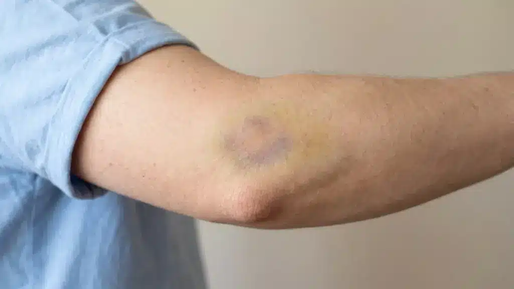 Close-up of a healing bruise on the elbow with purple and yellow discoloration on light skin