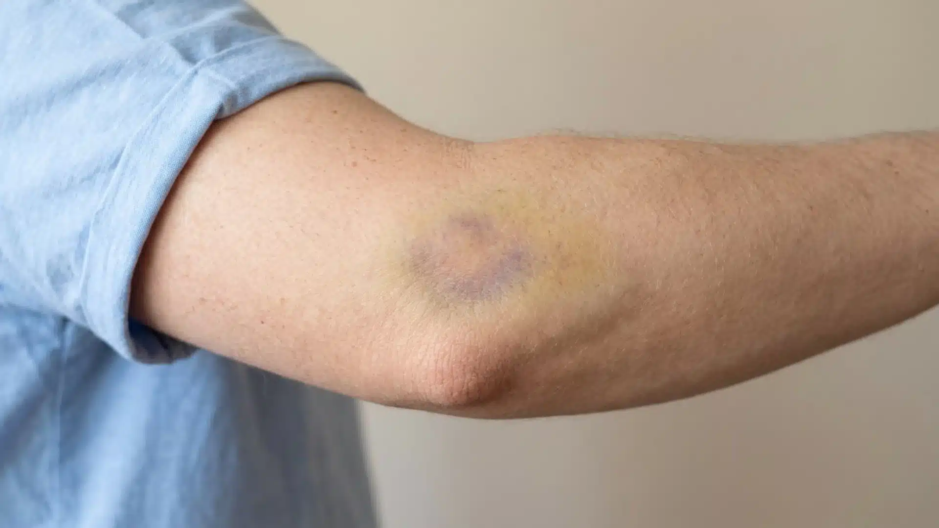 Close-up of a healing bruise on the elbow with purple and yellow discoloration on light skin