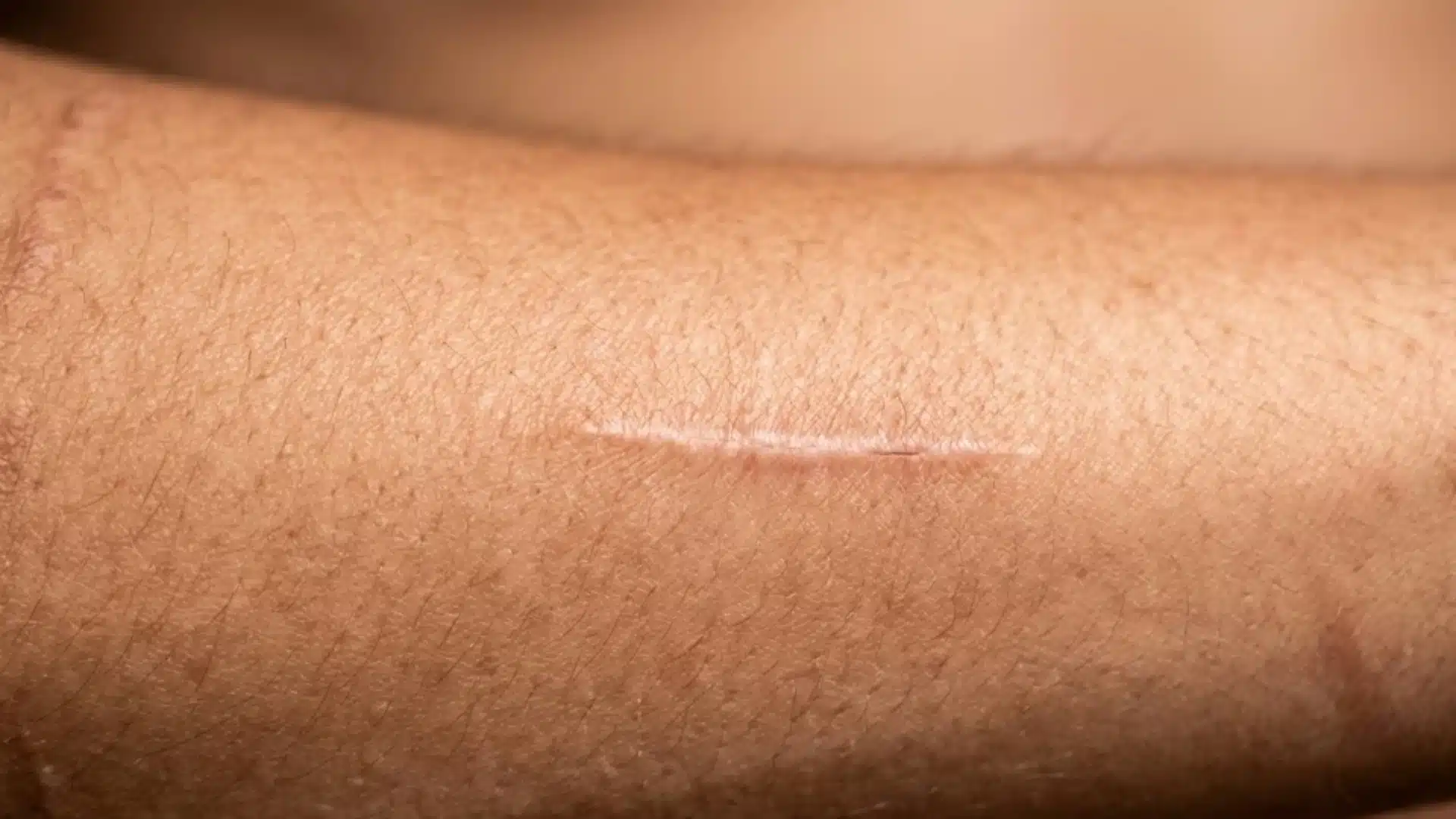 Close-up of a thin healed scar on a person's forearm with smooth skin texture and natural lighting