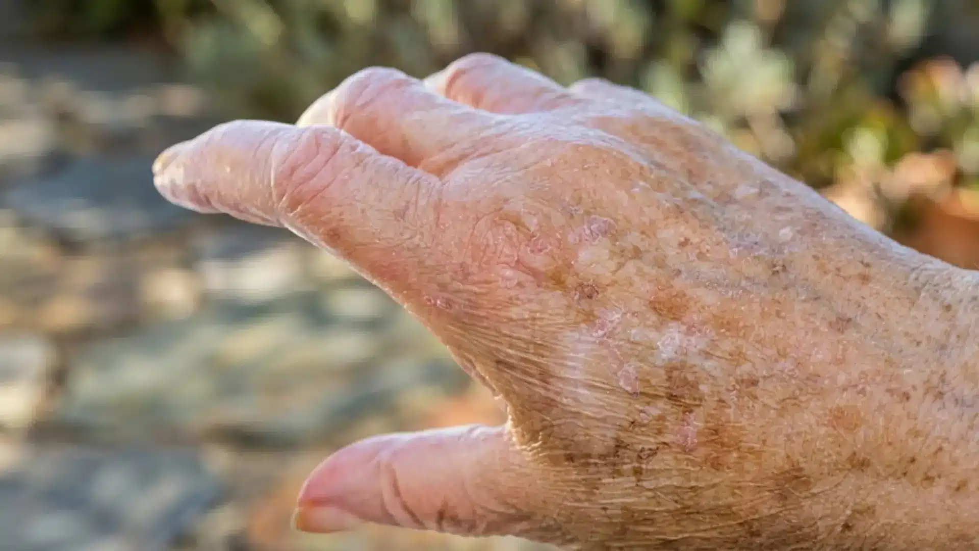 Close-up of an elderly hand showing sunspots, age spots, and dry skin outdoors