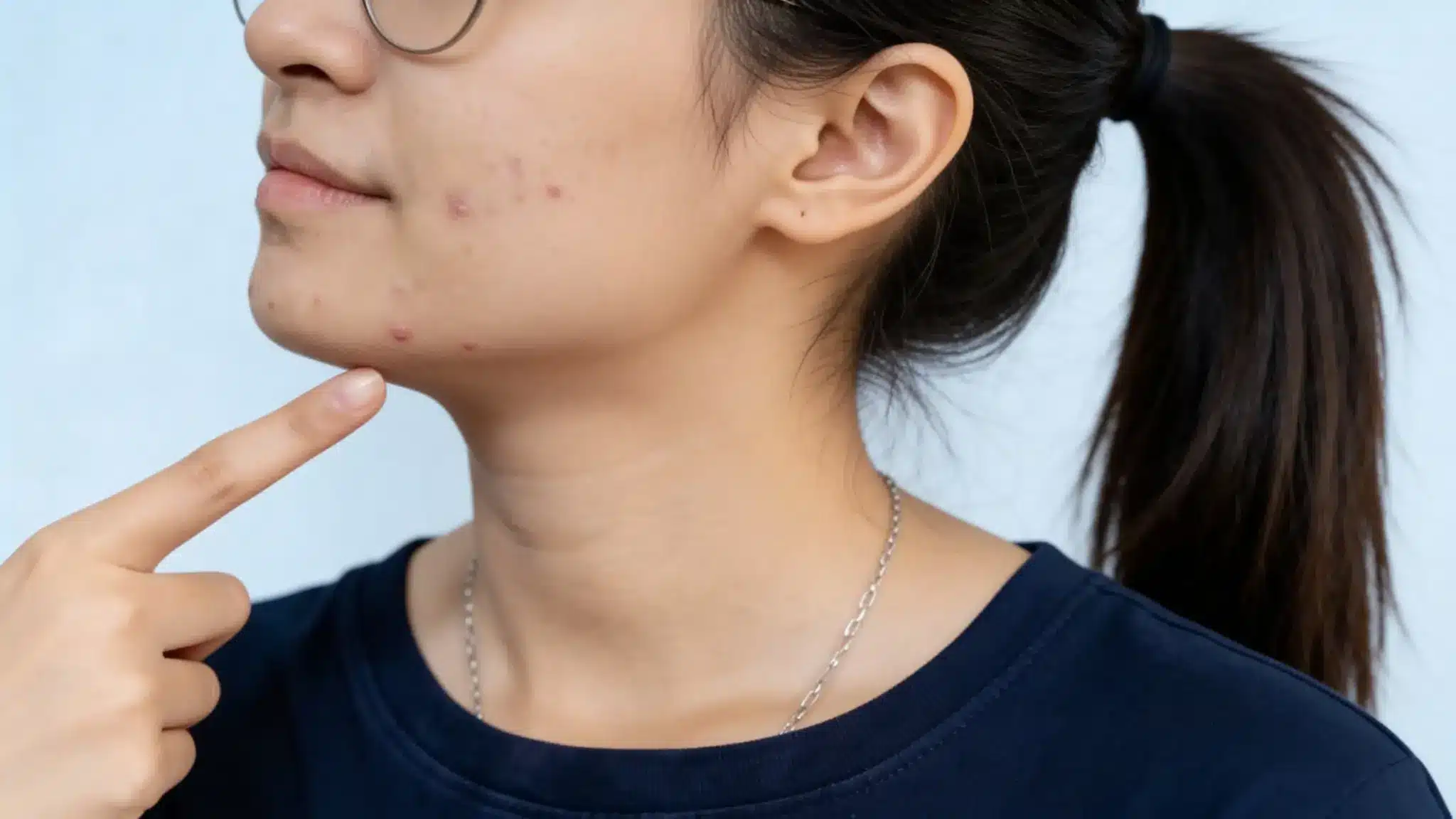 Close-up of chin acne with inflamed pimples, highlighting breakouts linked to diet and blood sugar spikes