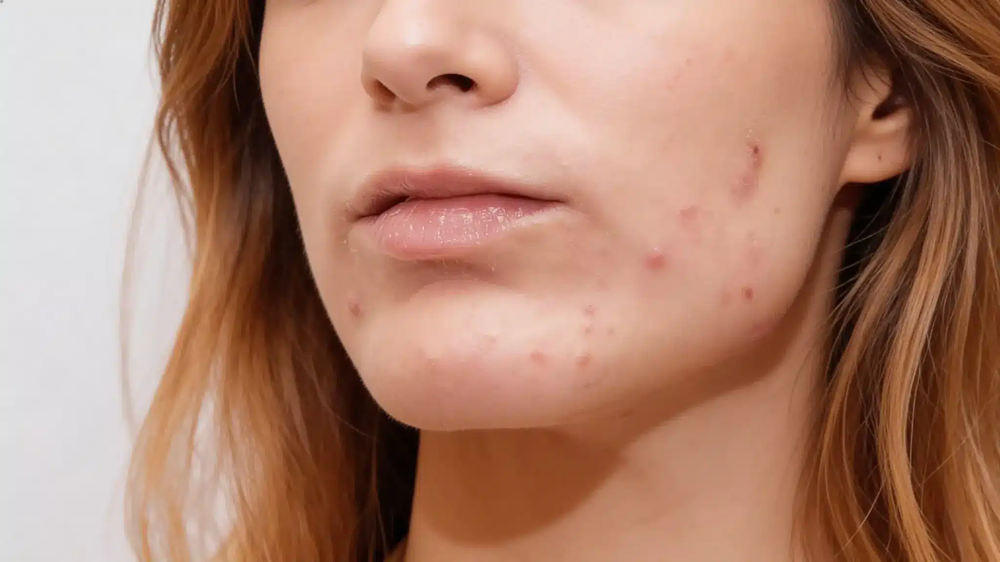 Close-up of chin acne with red pimples, illustrating breakouts caused by stress and elevated cortisol levels