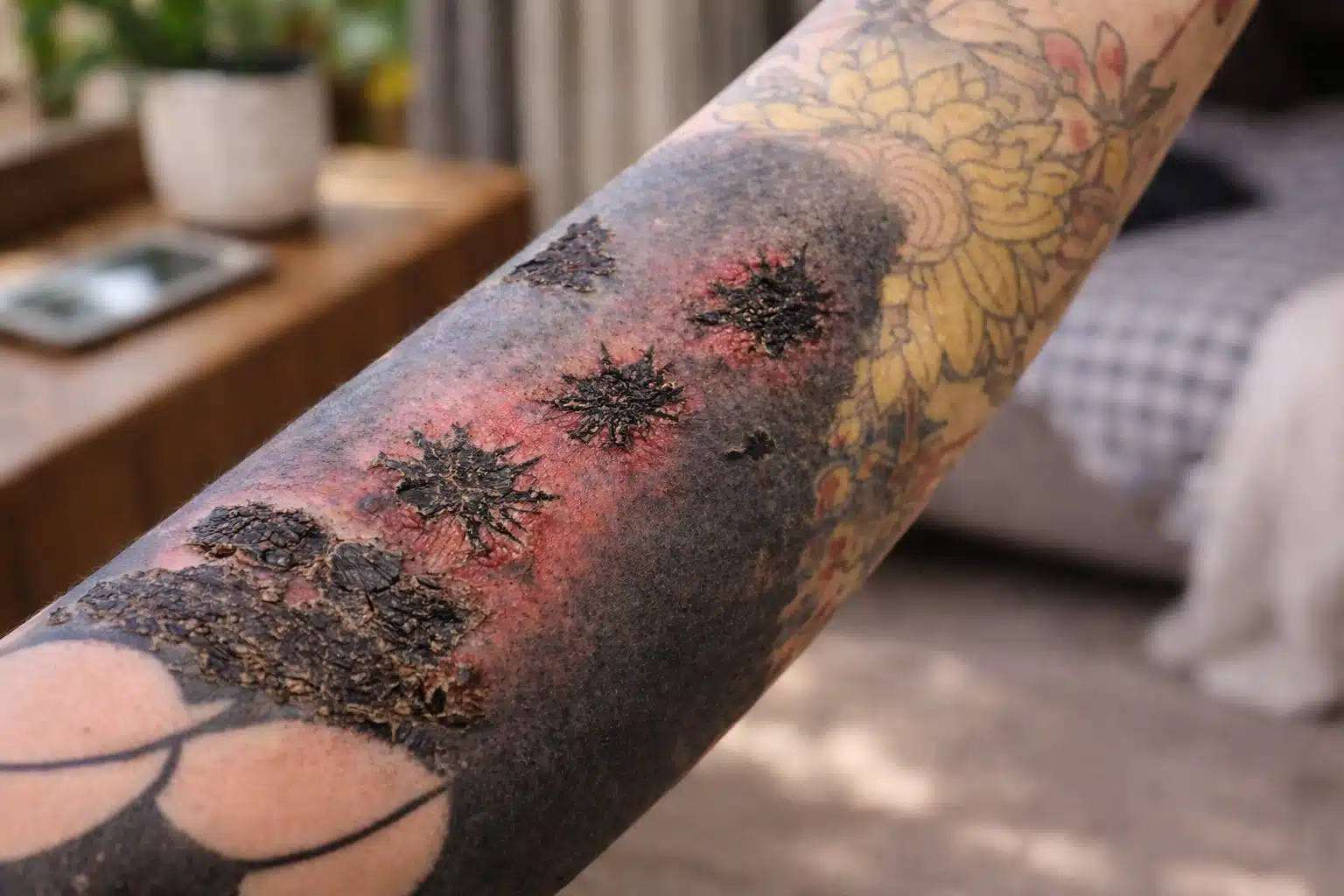 Close up of infected forearm tattoo with heavy scabbing, redness, and irritated skin