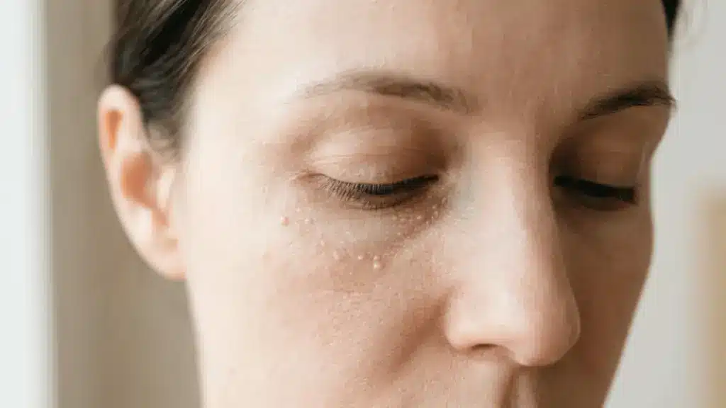 Close-up of milia bumps under eye on bare skin in natural light