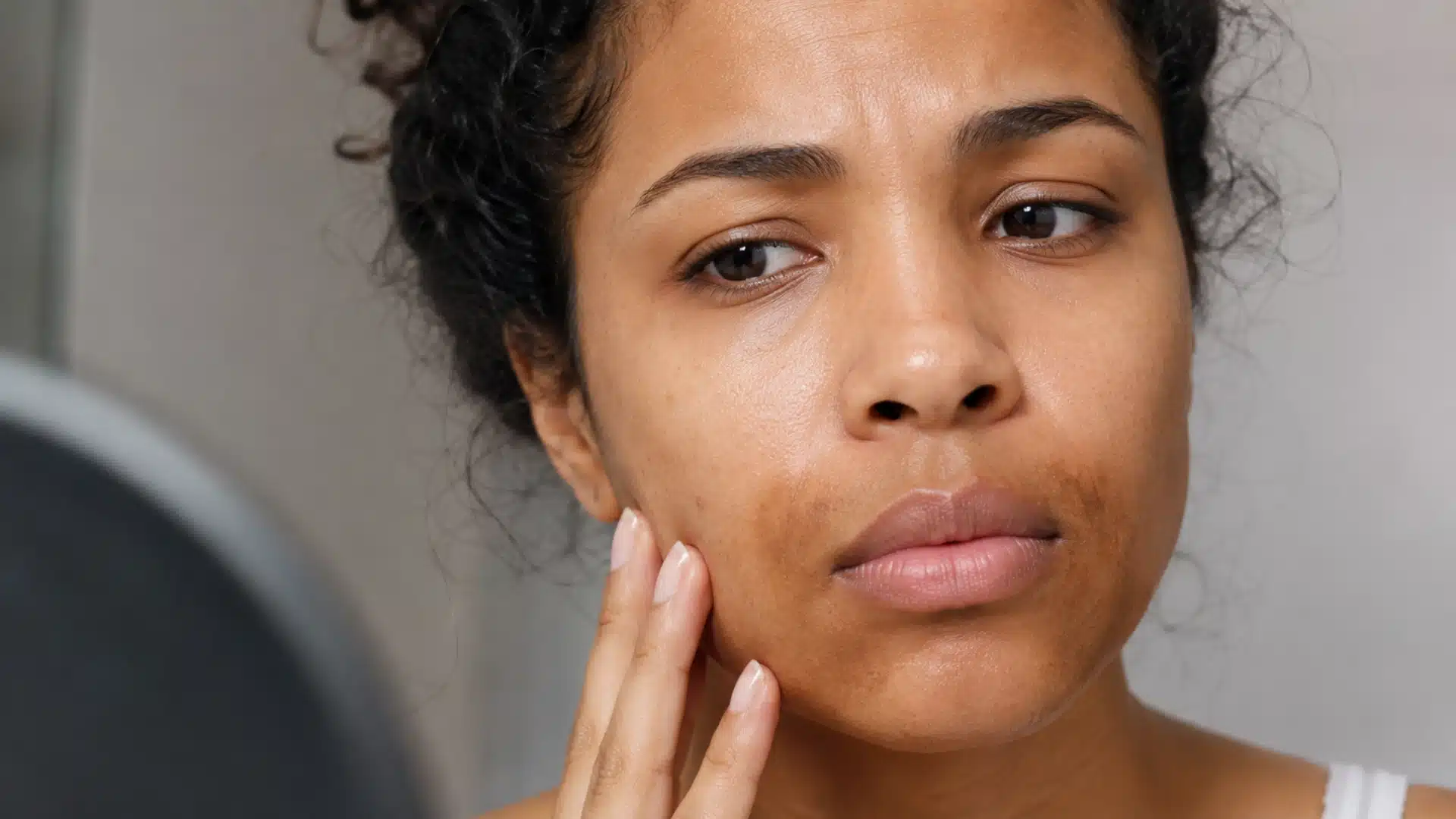 Close-up of mouth hyperpigmentation