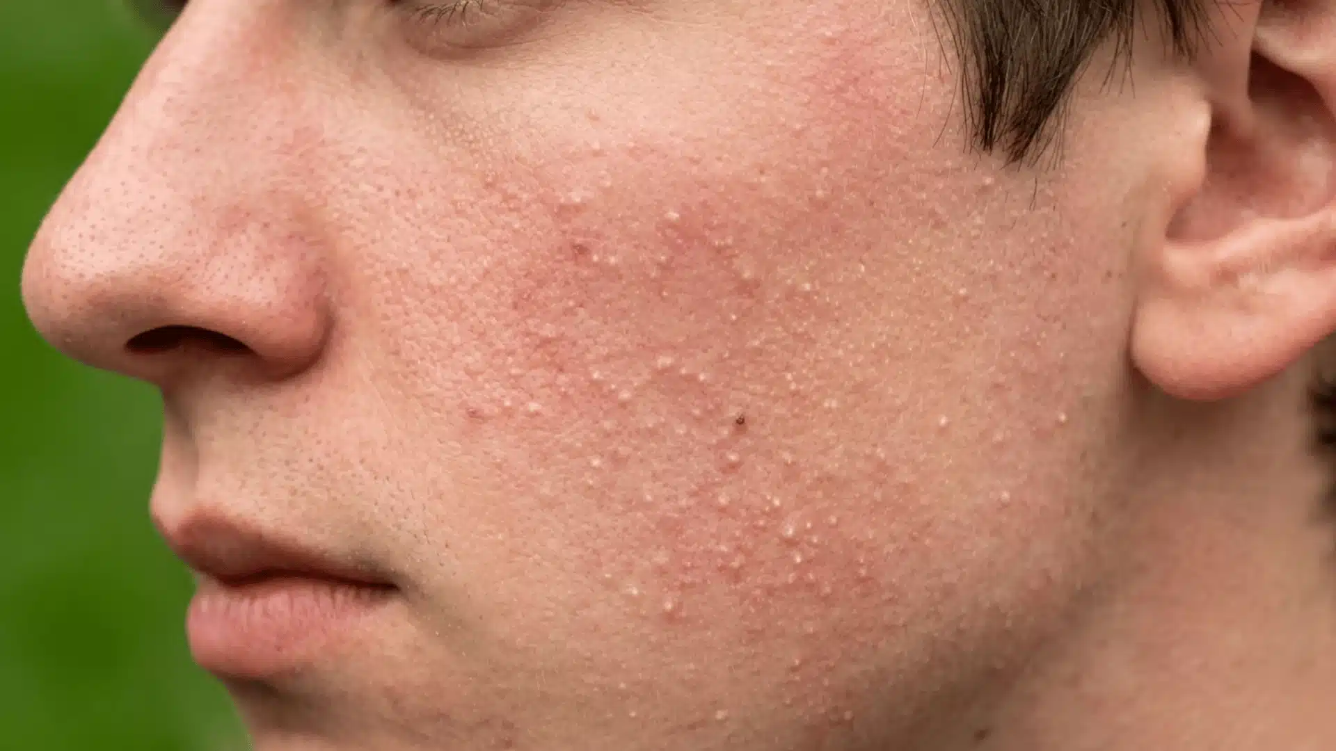 Close-up of a person's cheek showing small white bumps caused by milia on the face, with mild redness in profile