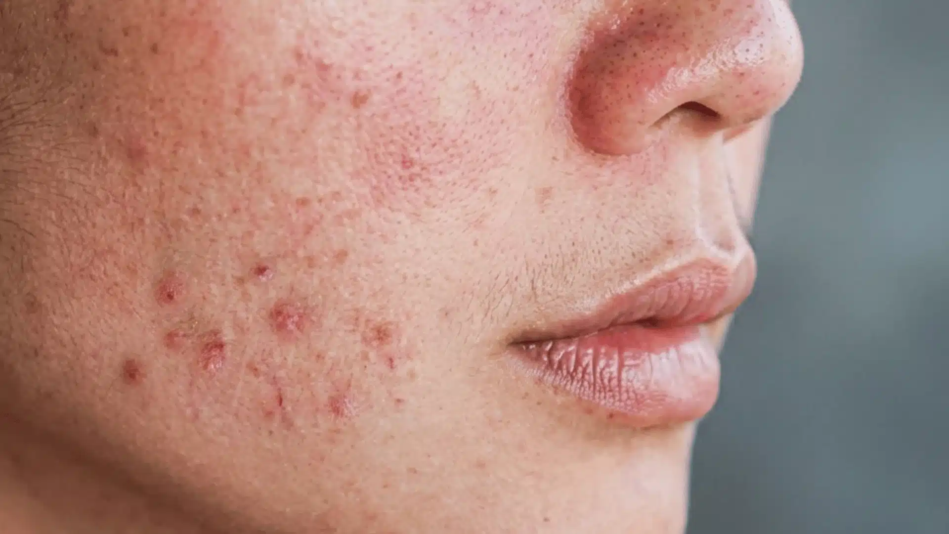 Close-up of facial acne with red pimples and inflamed skin on cheek and jawline