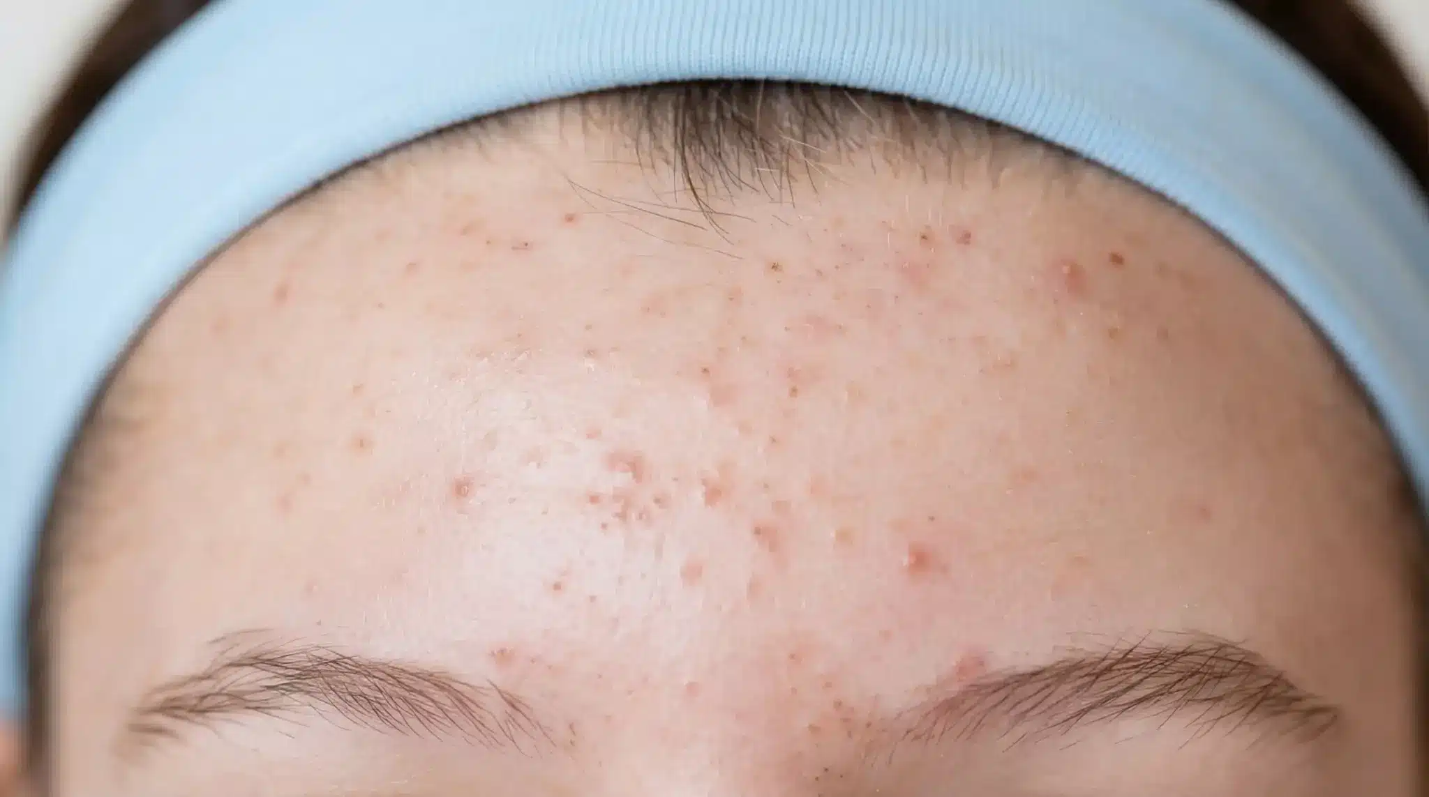 Close-up of forehead acne under a headband, showing how hats, helmets, or tight accessories can trigger breakouts