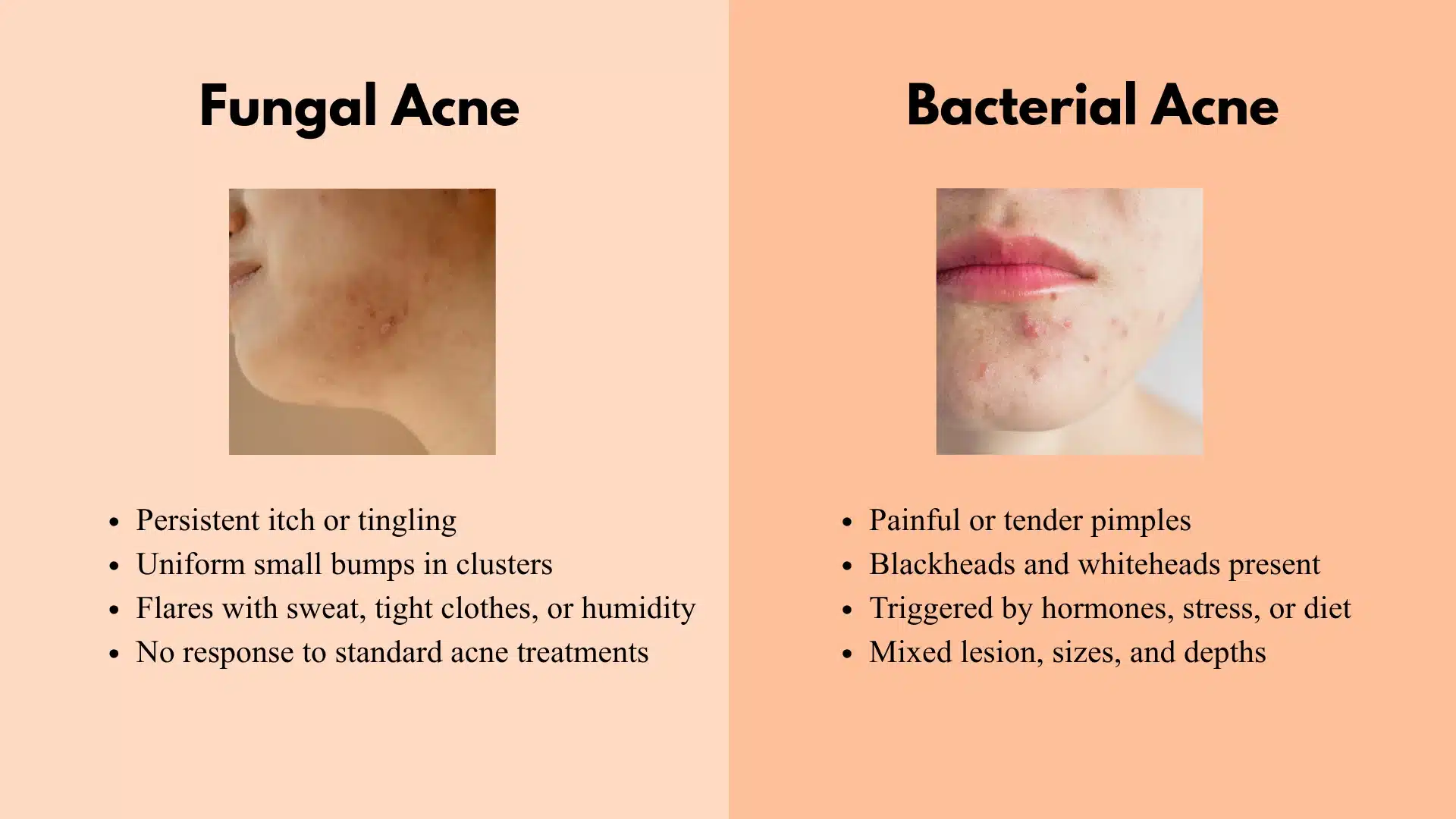 Comparison of fungal vs bacterial acne with key symptoms, showing clustered bumps vs inflamed pimples and triggers