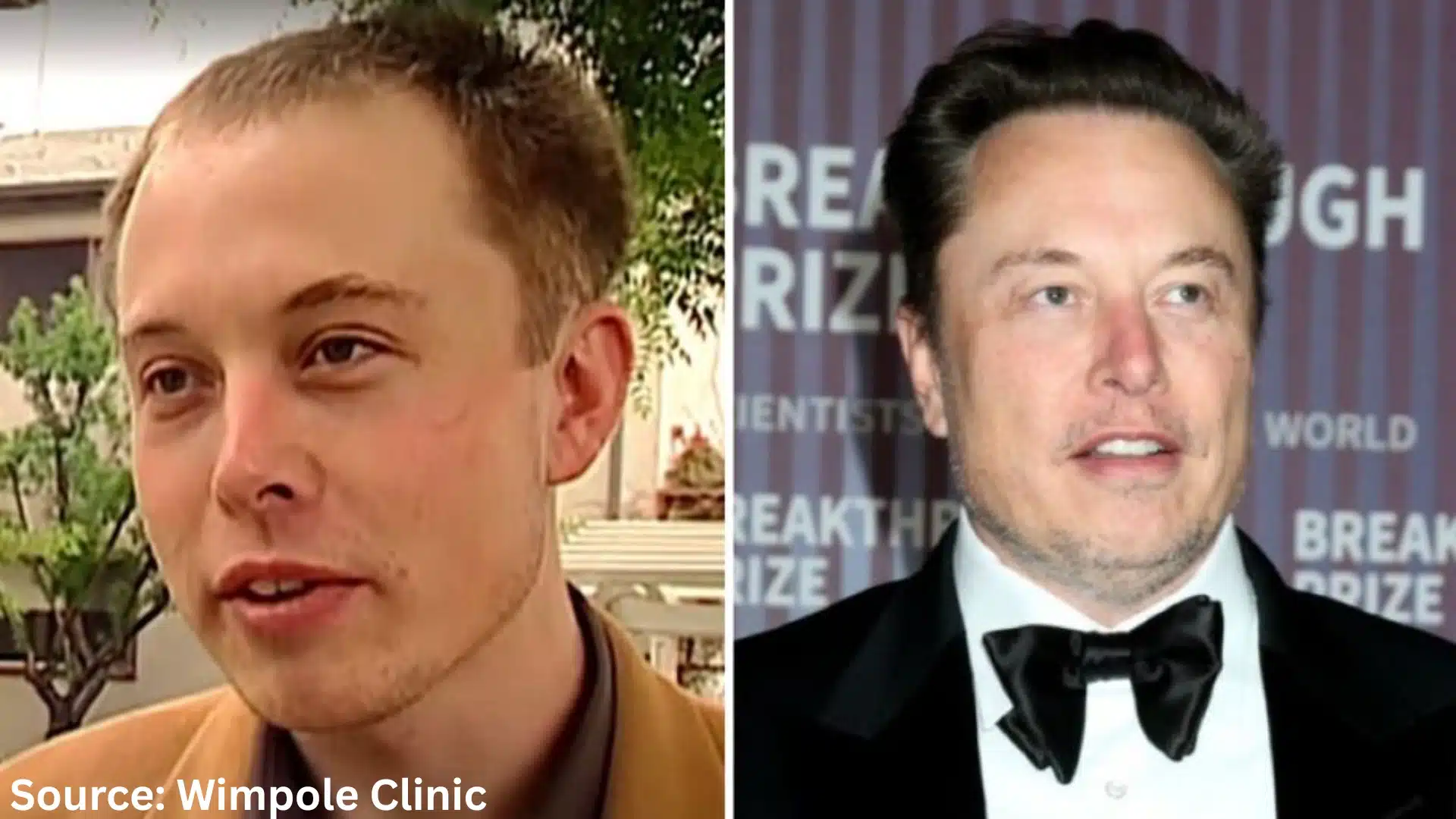 Elon Musk hair transplant before and after