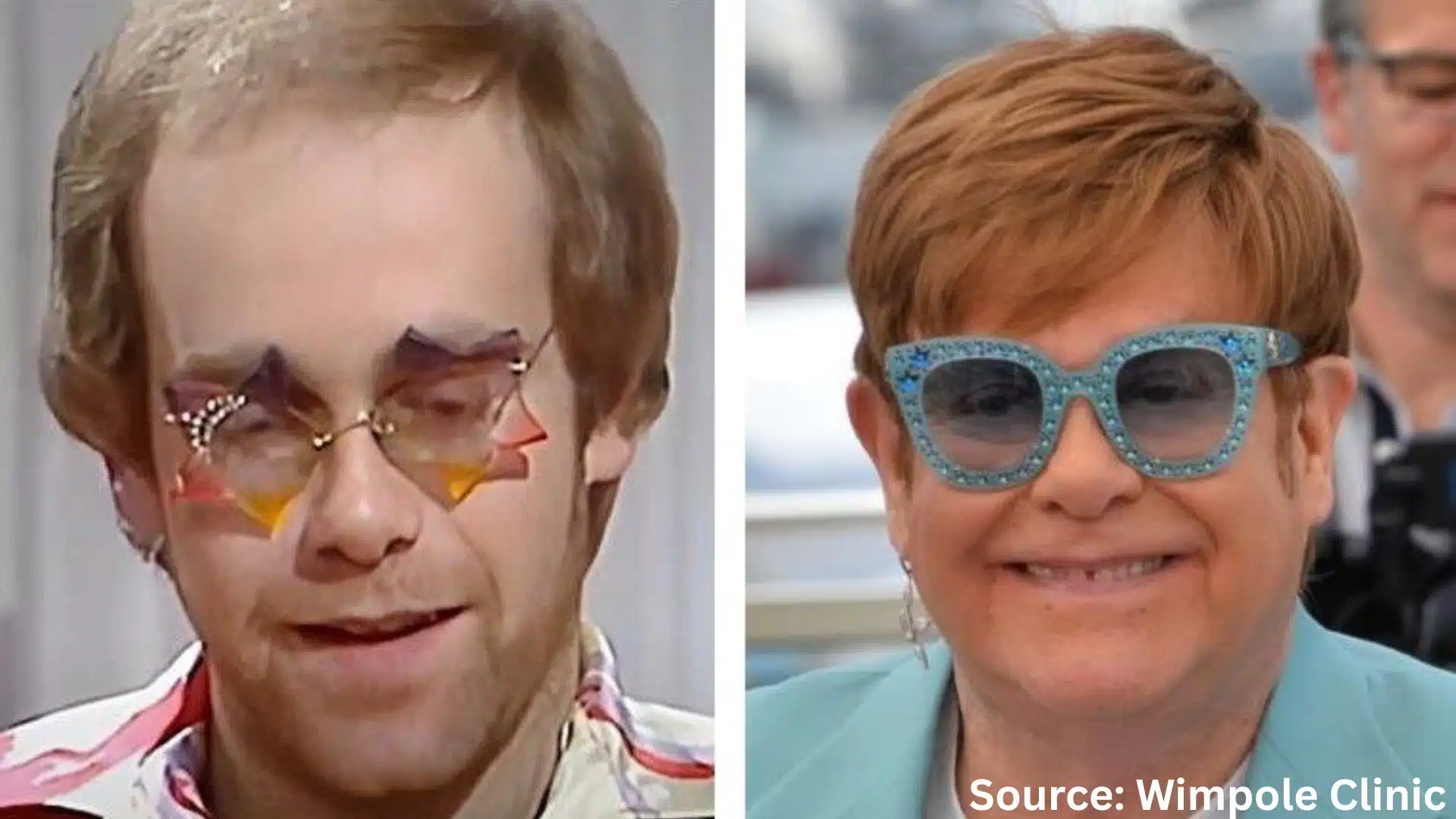 Elton John hair transplant before and after