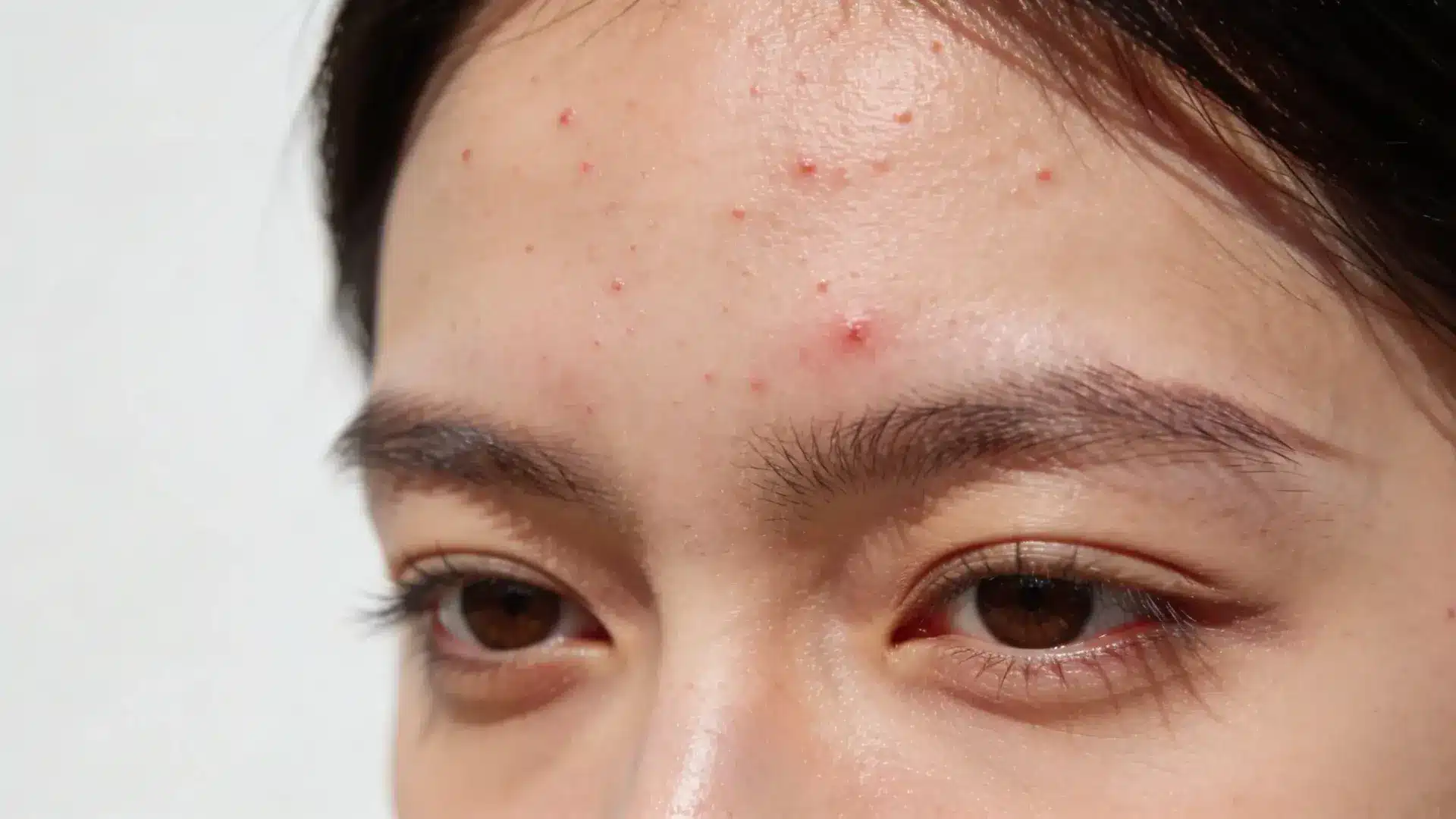 Face with visible forehead acne including inflamed pimple and scattered small bumps
