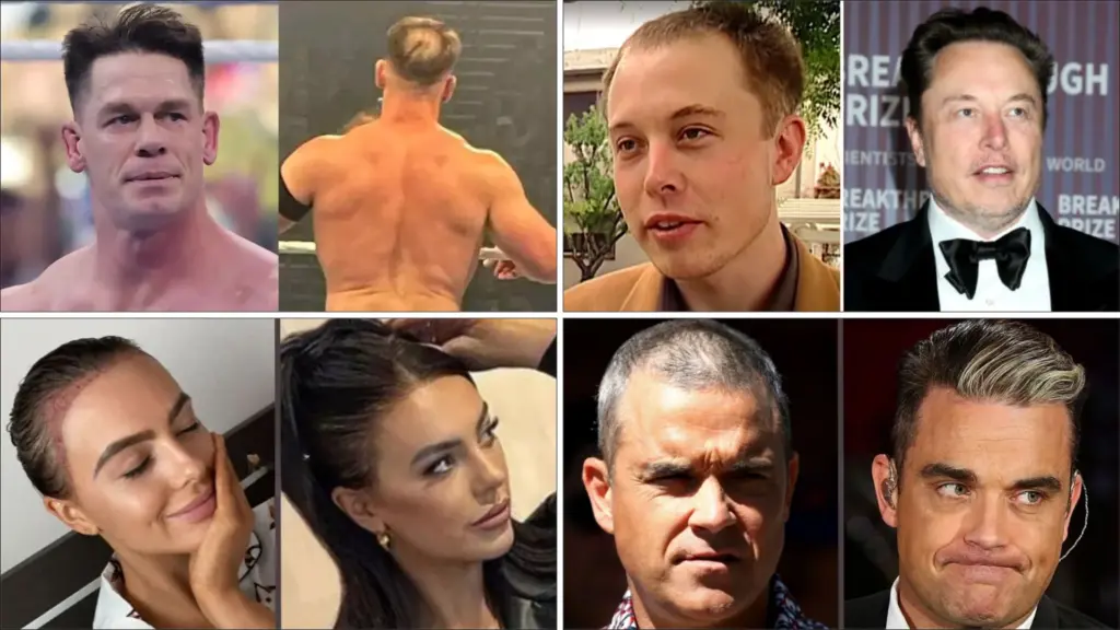 Famous Celebrity hair transplant comparison