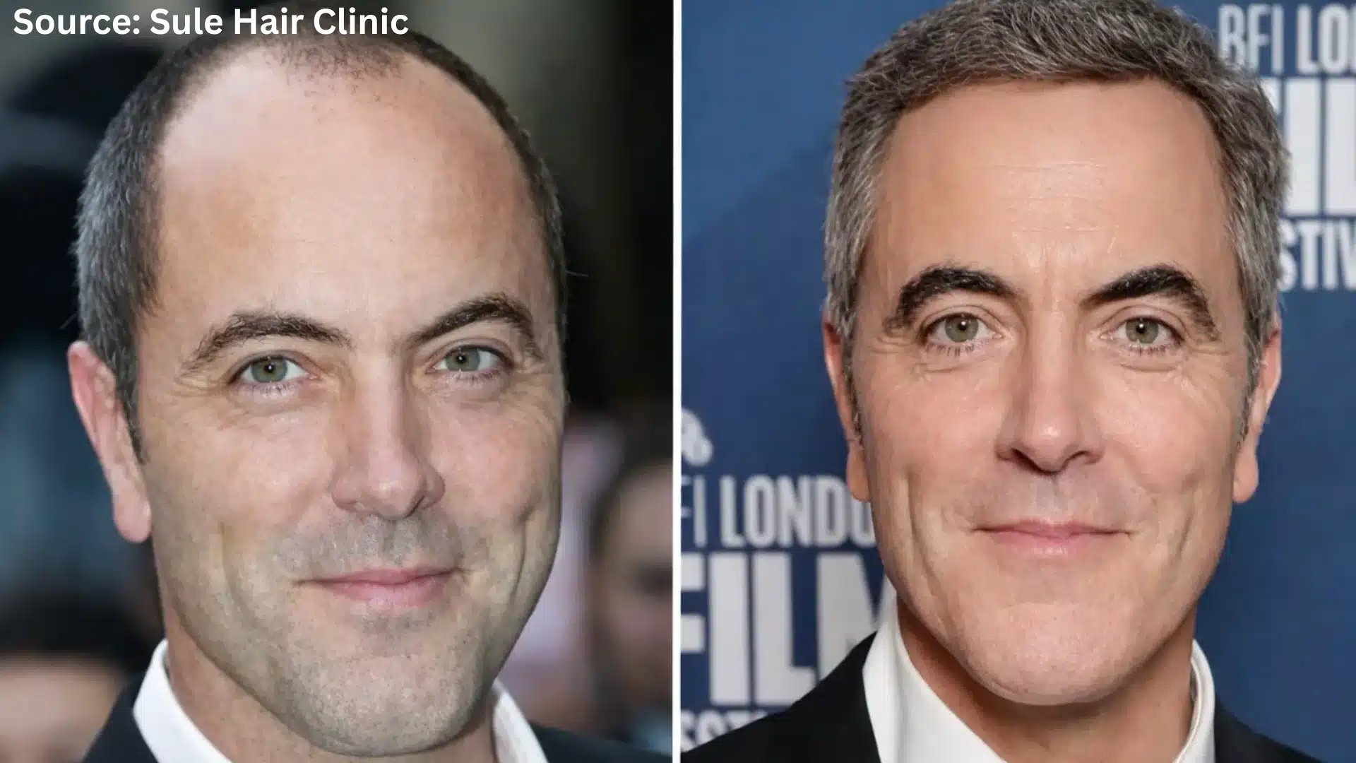 James Nesbitt hair transplant before and after
