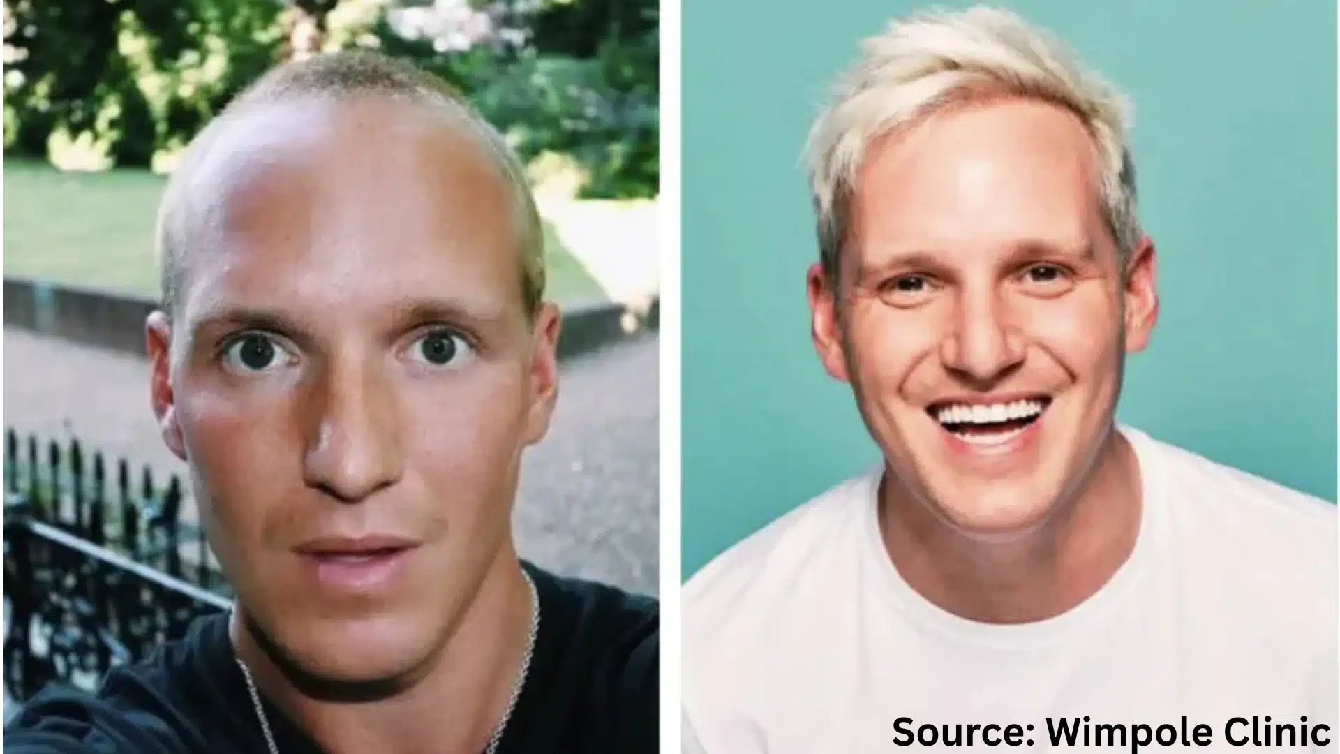 Jamie Laing hair transplant before and after