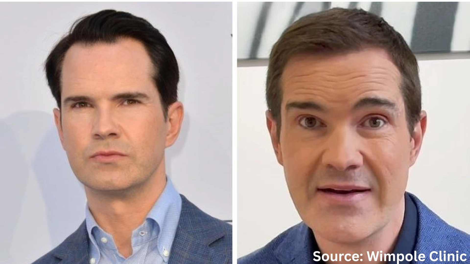Jimmy Carr hair transplant before and after