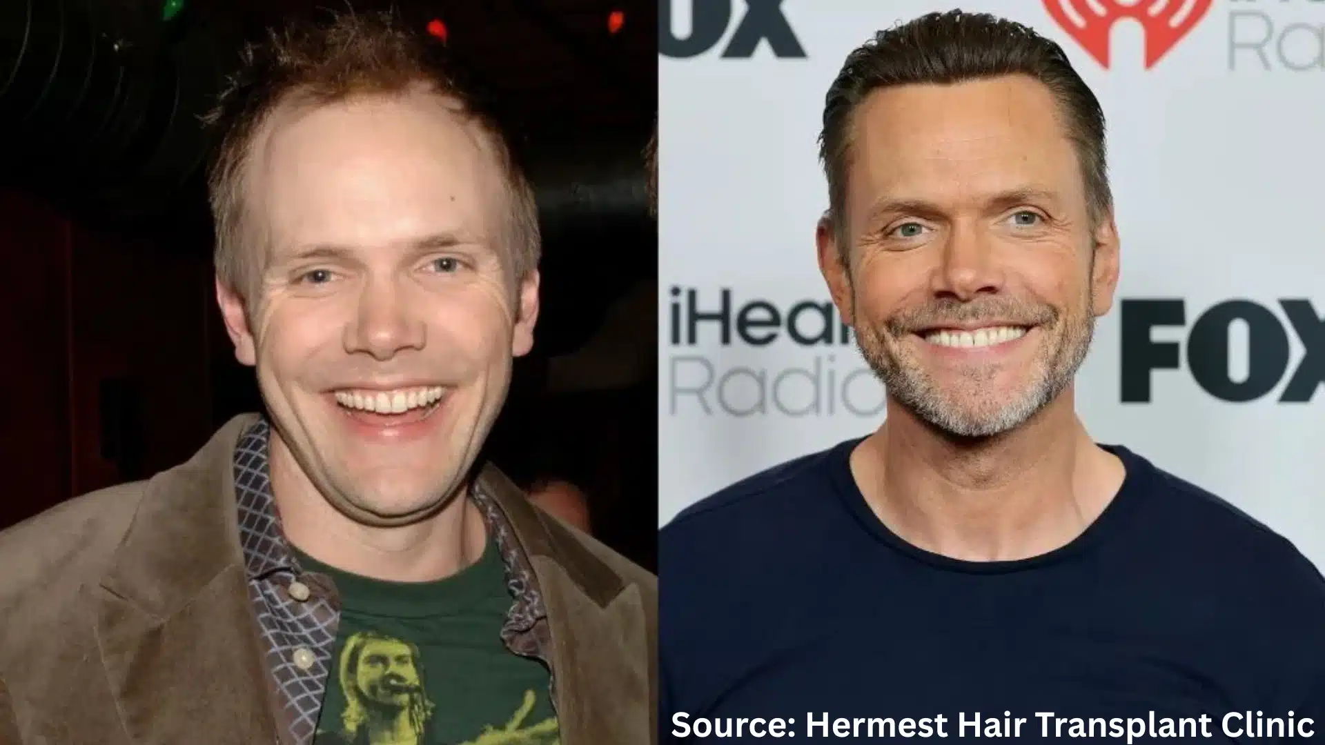 Joel McHale hair transplant before and after