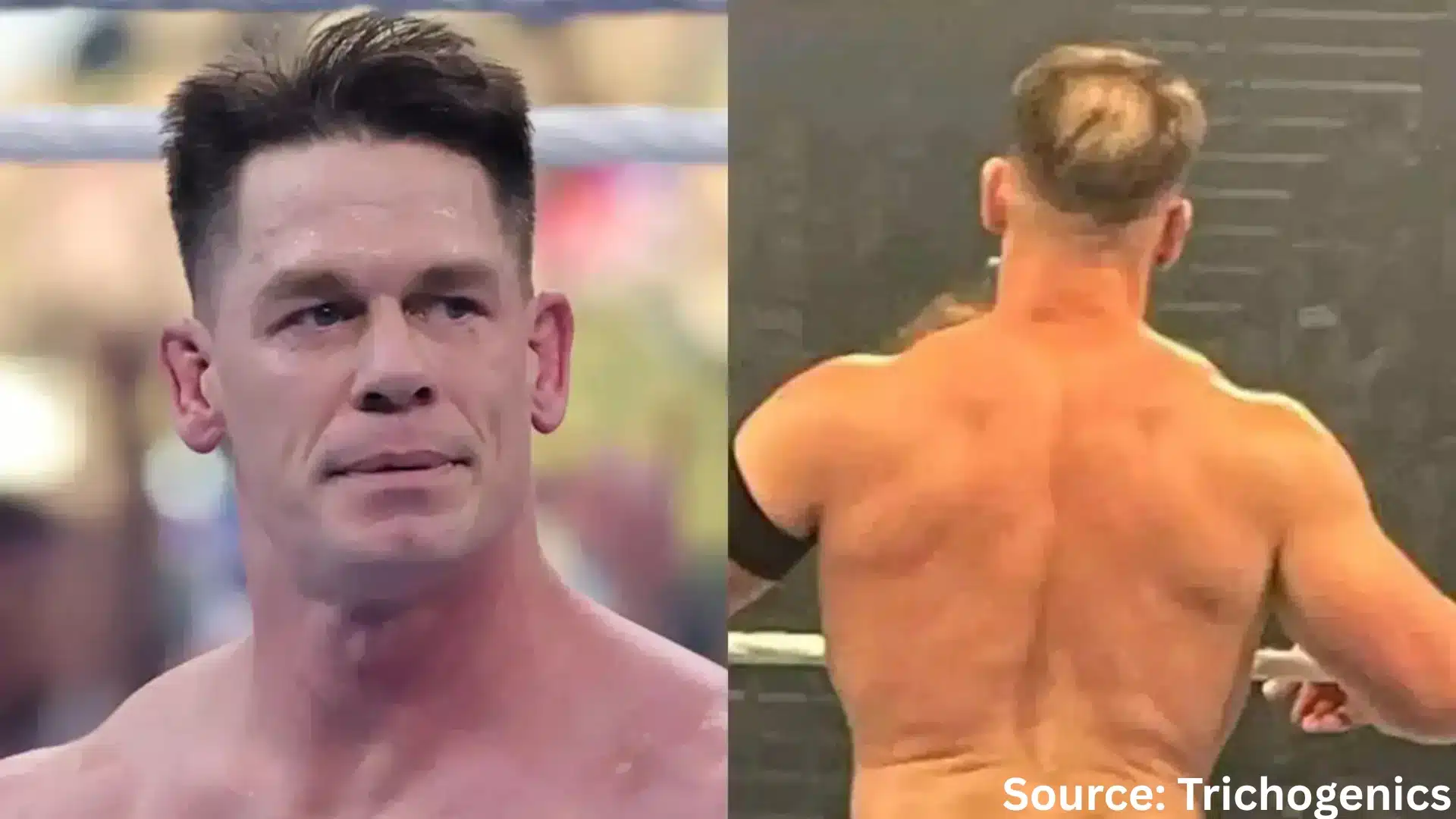 John Cena hair transplant before and after