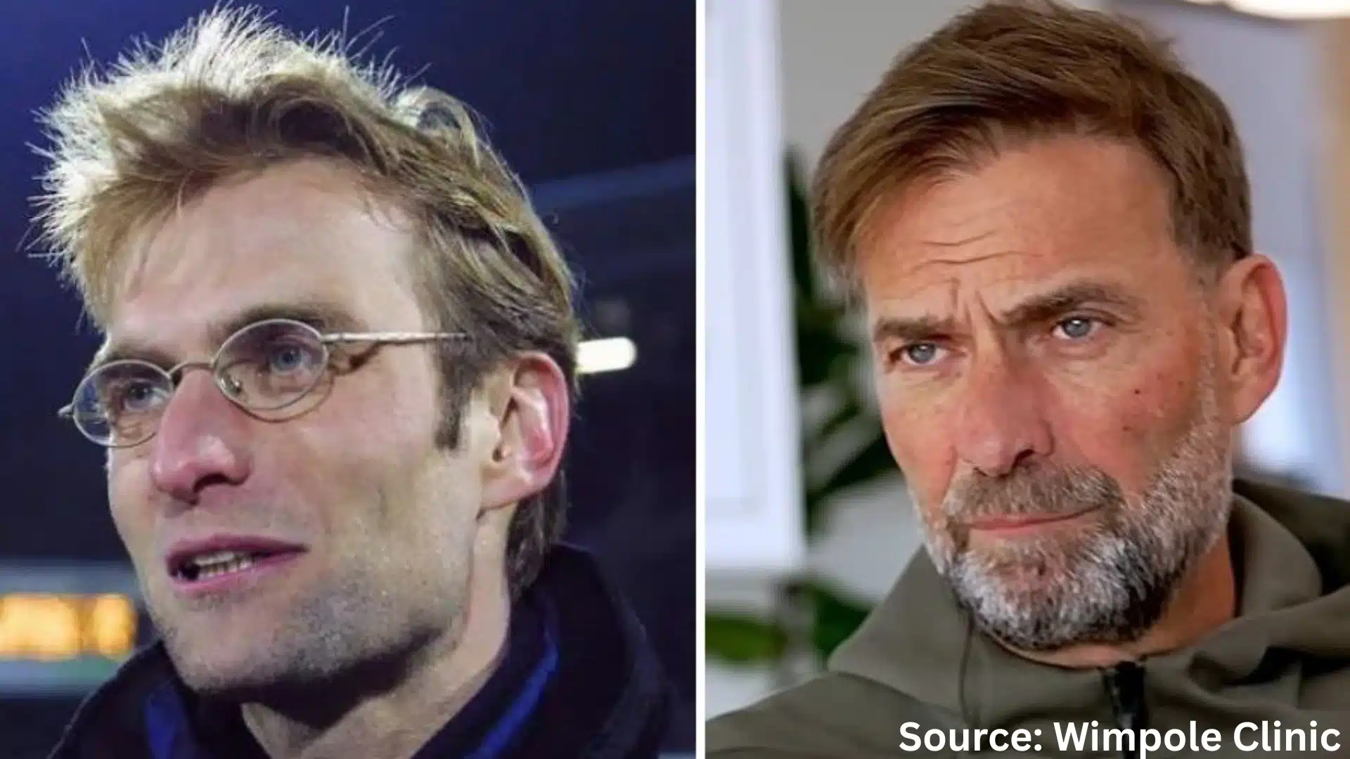 Jurgen Klopp hair transplant before and after